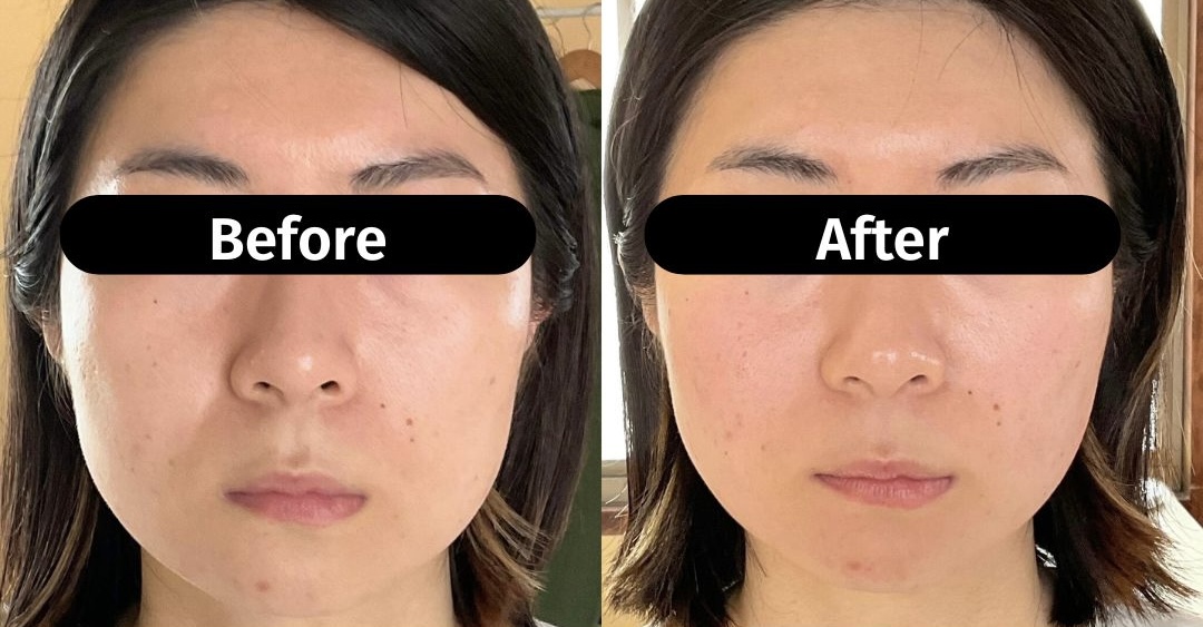 美容鍼灸サロン〜MIYABI〜 エラ張り改善 美容鍼のメニュー画像