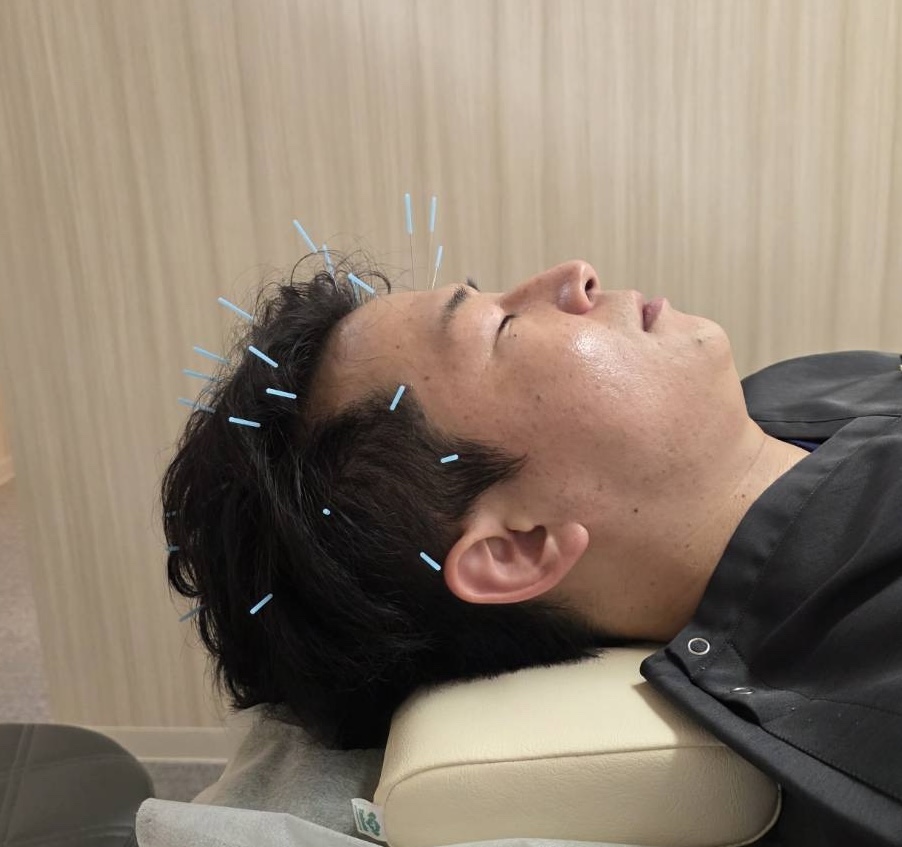 中村鍼灸院広島院スタッフ予約専用 ◉育毛はり(頭皮環境を整えて髪を太く生えやすくします)のメニュー画像