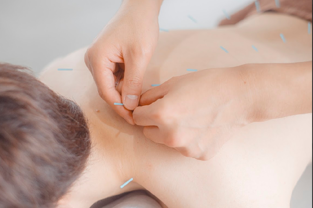 シュラーフ鍼灸院 【2回目以降の方】鍼灸のメニュー画像