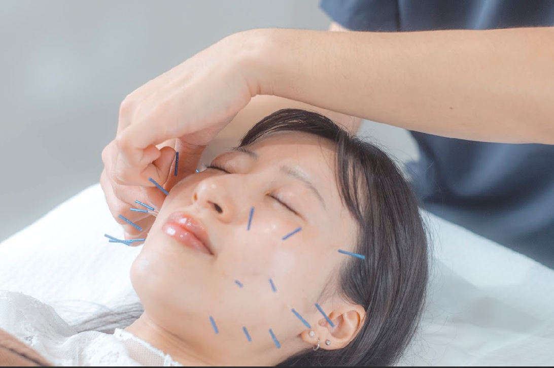シュラーフ鍼灸院 【２回目以降の方】　美容鍼のメニュー画像