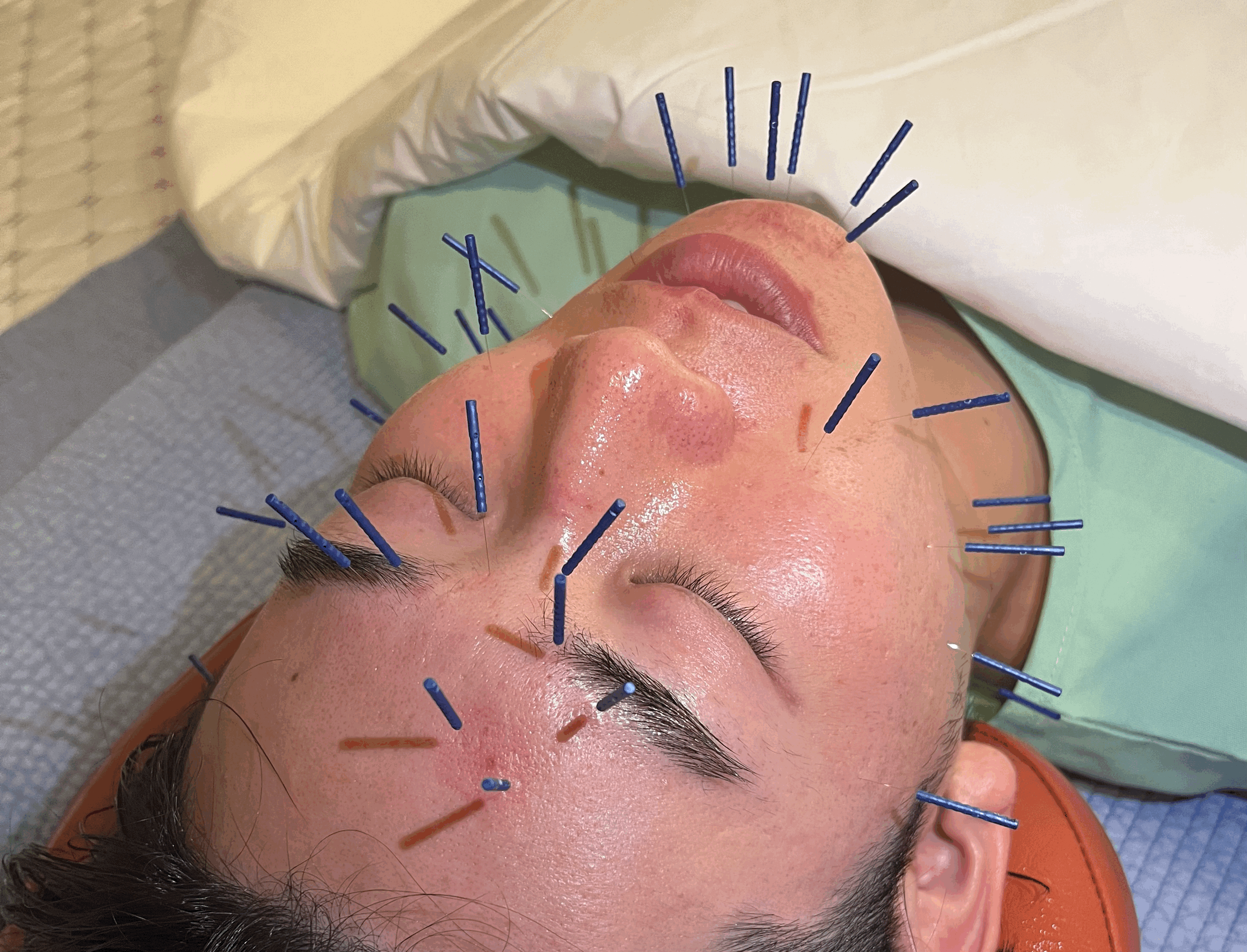 TAKAHANA鍼灸院 『初回限定』エステ美容鍼　肌質改善のメニュー画像