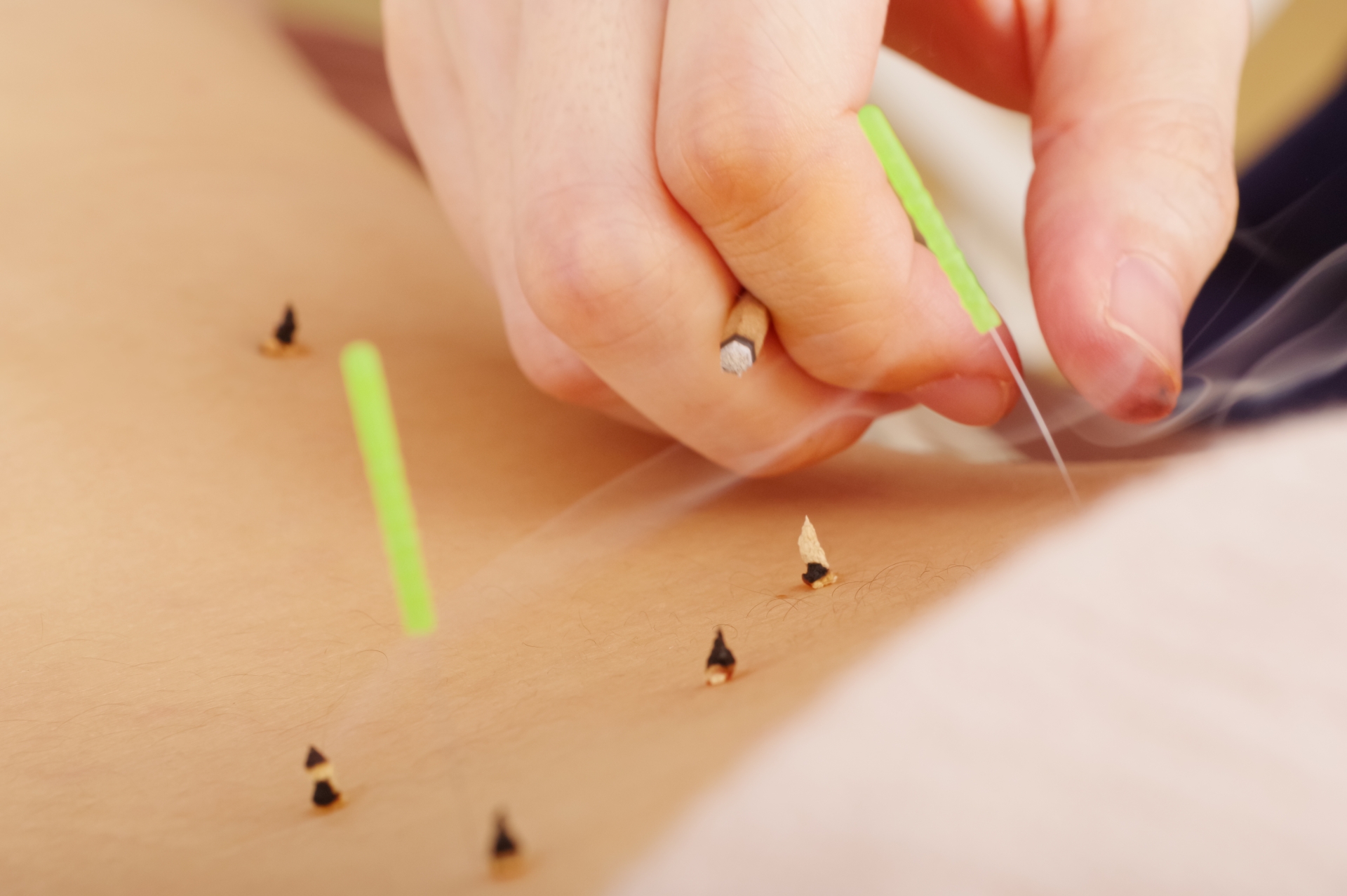 鍼灸・指圧　那須慈弘治療院 鍼灸・指圧　総合治療のメニュー画像