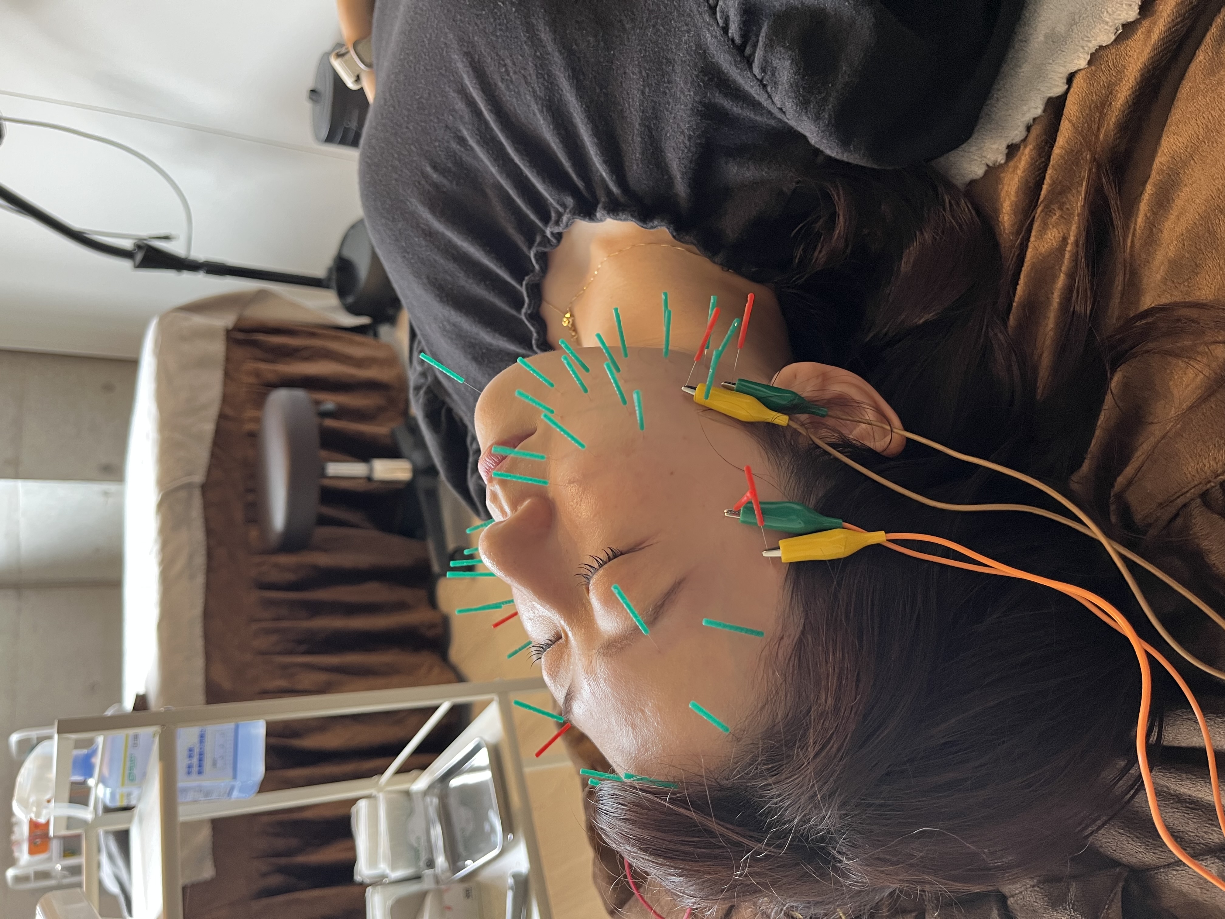 みやび鍼灸サロン 美容鍼＋小顔矯正のメニュー画像