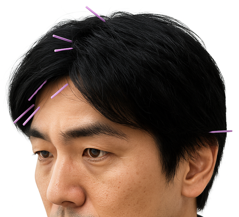 ごほう美鍼灸院 YNSAコースのメニュー画像