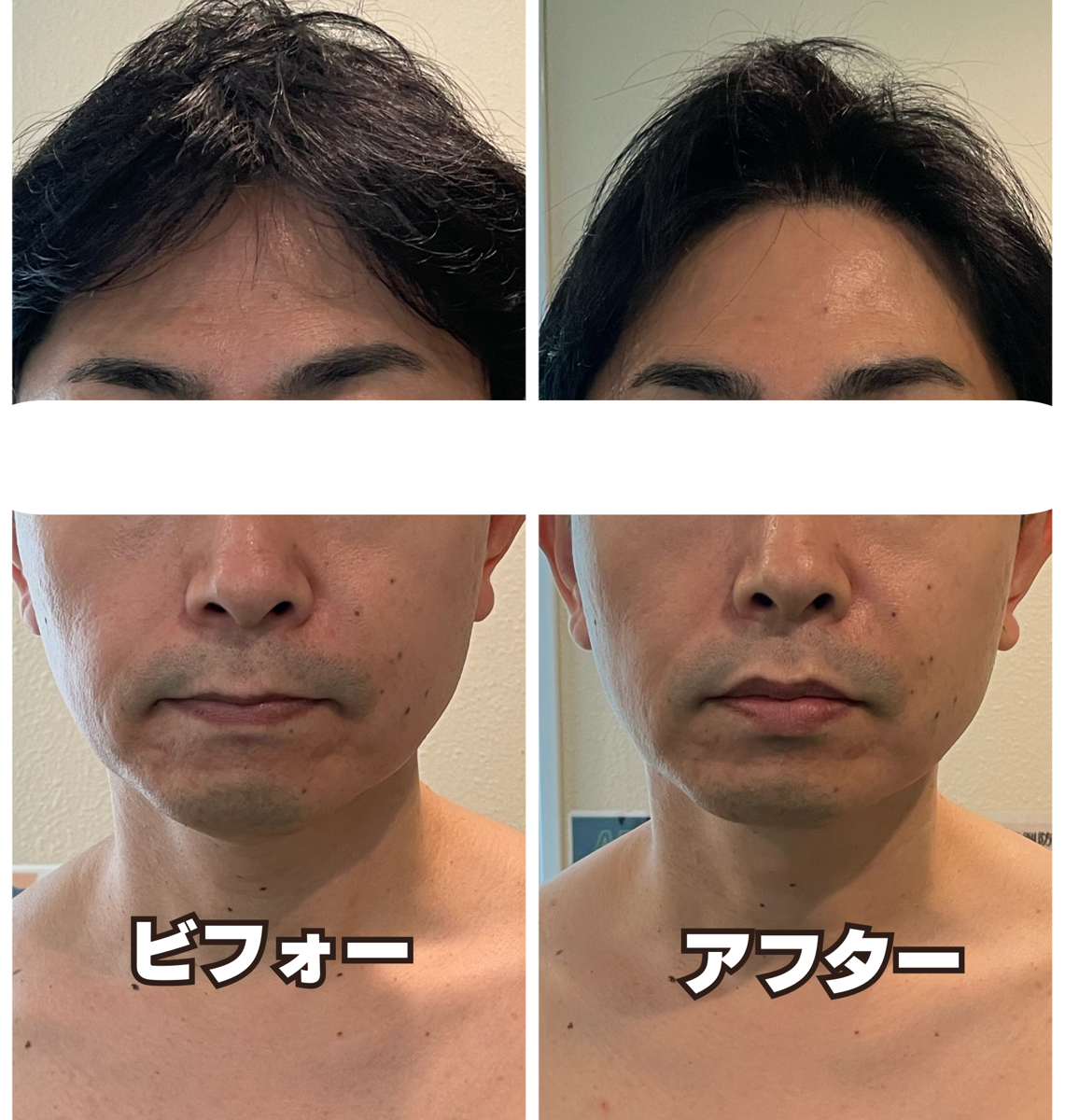 Akira鍼灸Conditioning Lab メンズ美容はりのメニュー画像