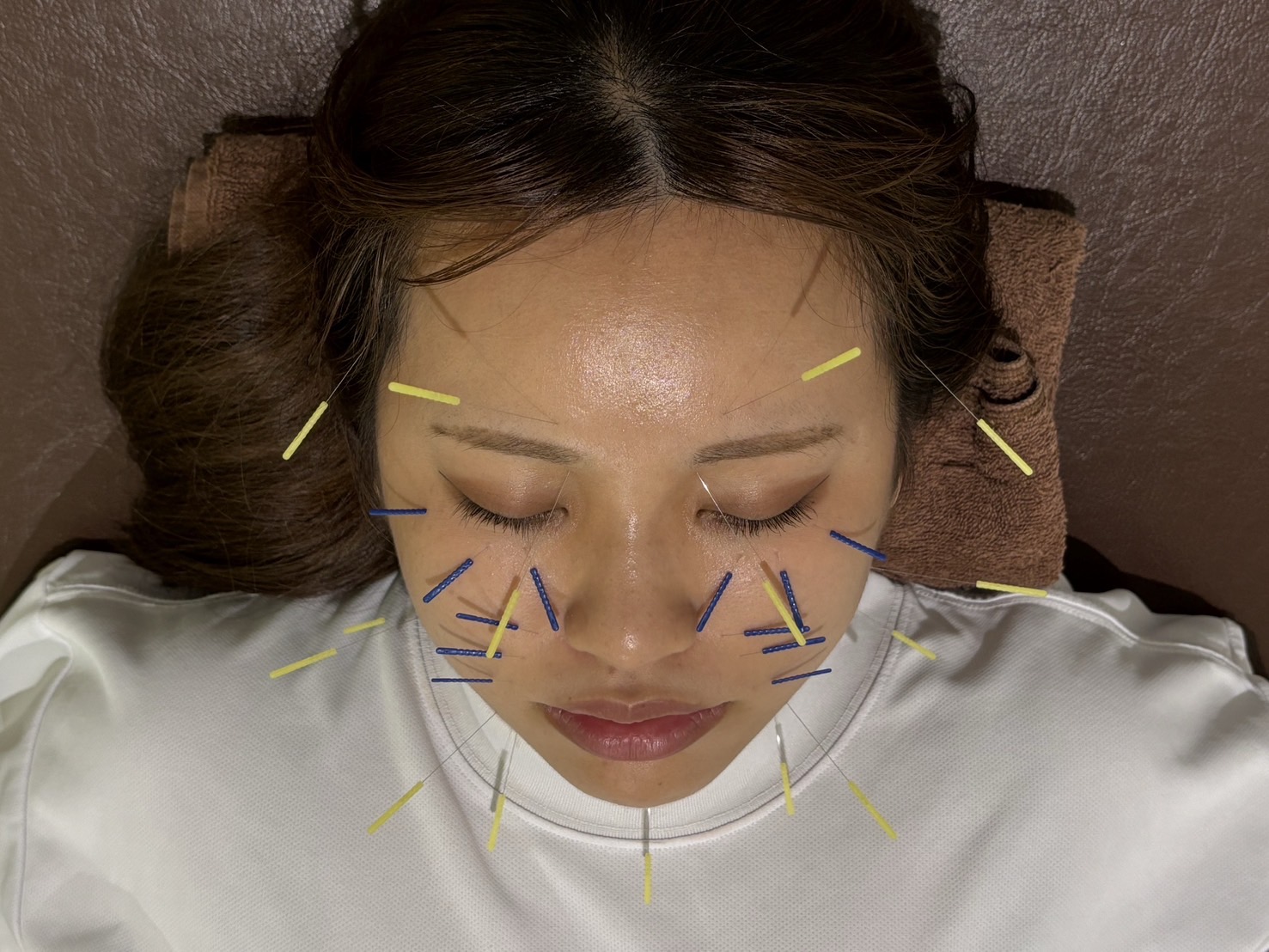 よもぎ鍼灸整骨院 【美容鍼 初回限定 改善体感コース】むくみ、たるみ、速攻変化のメニュー画像