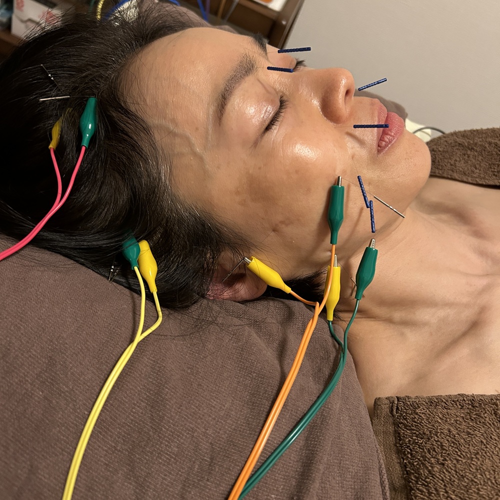 kokokara鍼灸Prana 【2回目以降の方】美容鍼　ベーシック　50分のメニュー画像