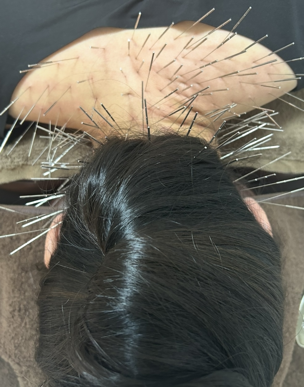 Iris鍼灸マッサージ上野院【ルート治療専門】 ルート治療　15分のメニュー画像