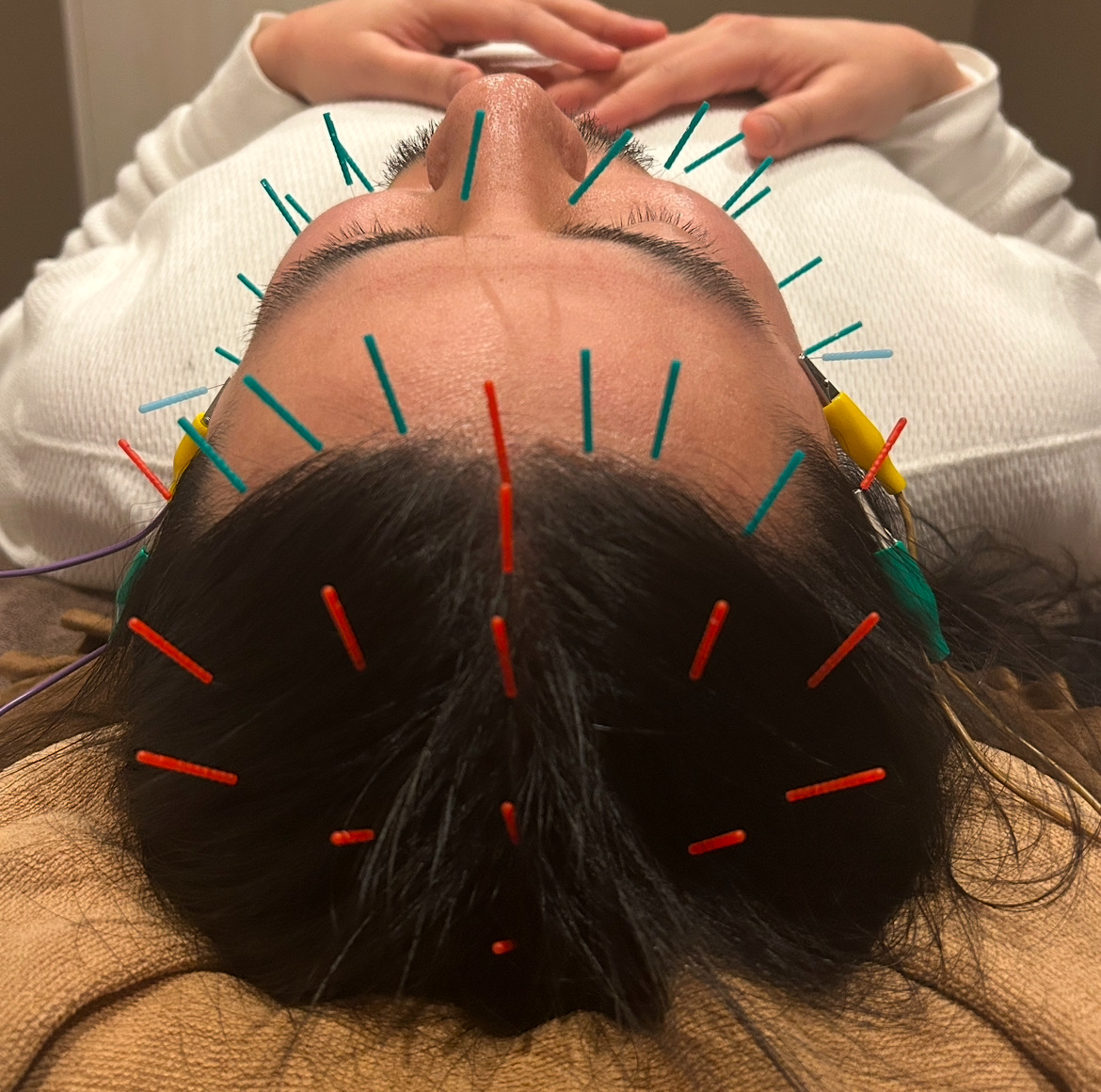 みやび鍼灸サロン 睡眠矯正鍼のメニュー画像