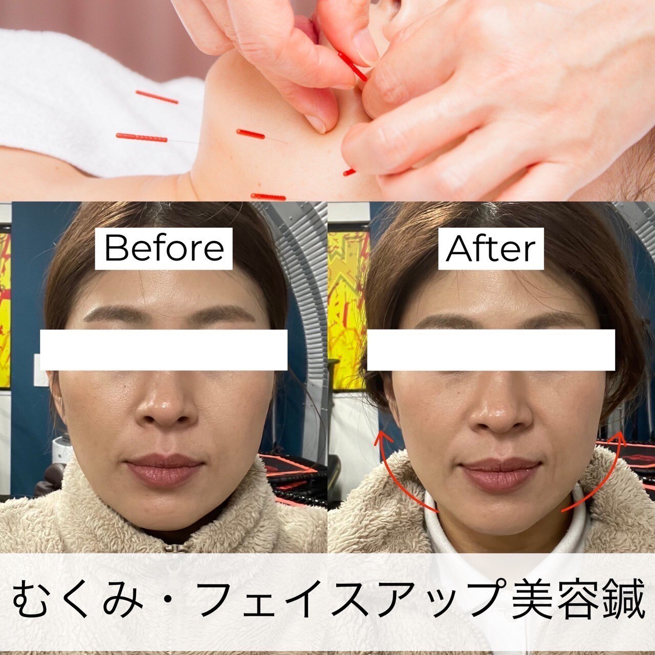 ヒューマン鍼灸接骨院 【効果絶大◎美容鍼＋小顔矯正＋頭蓋骨矯正】￥10000→￥3980のメニュー画像