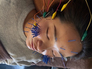 まつもと鍼灸院 【10月 キャンペーン残り3名】初回 リフトアップ美容鍼のメニュー画像