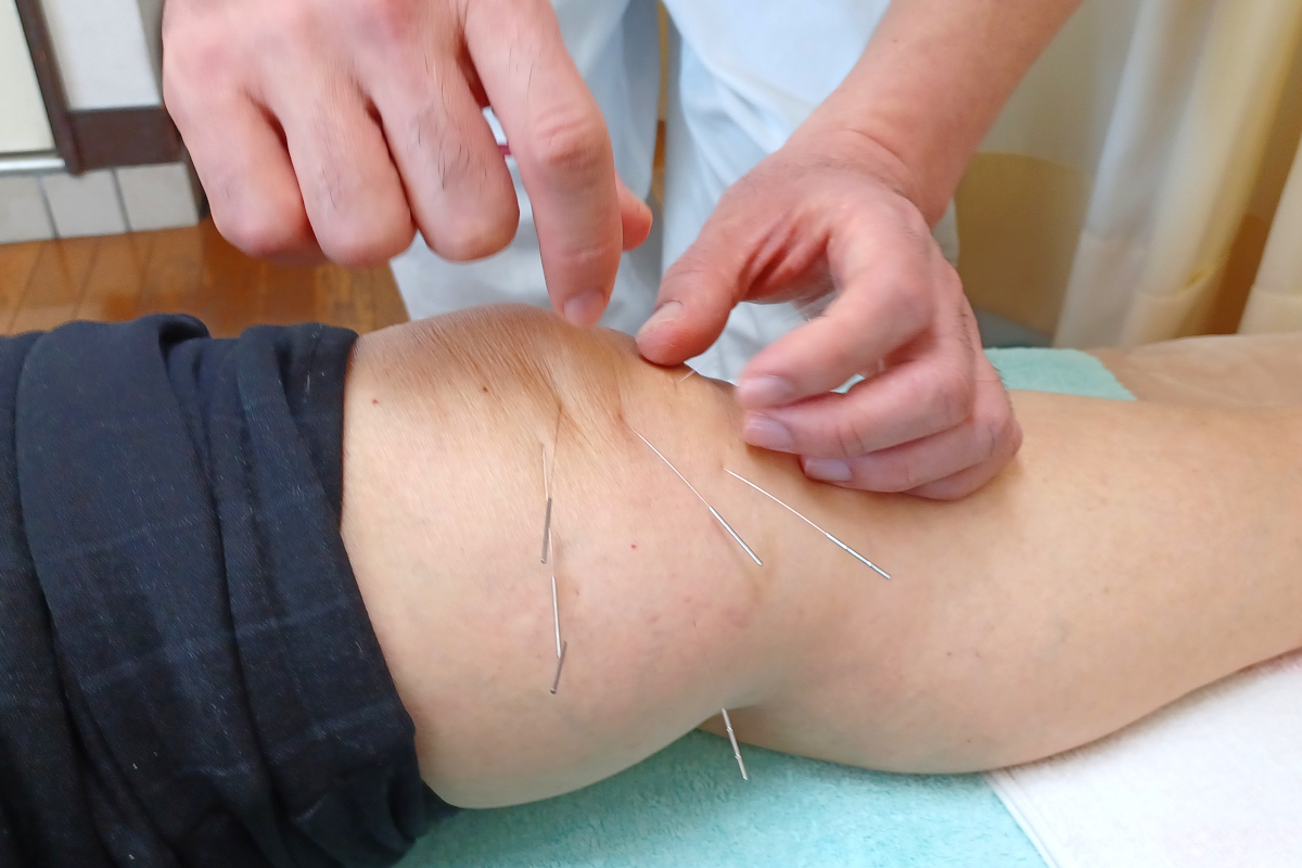 桶川朝日鍼灸院 追加・鍼灸部分治療【手技療法　専用】のメニュー画像