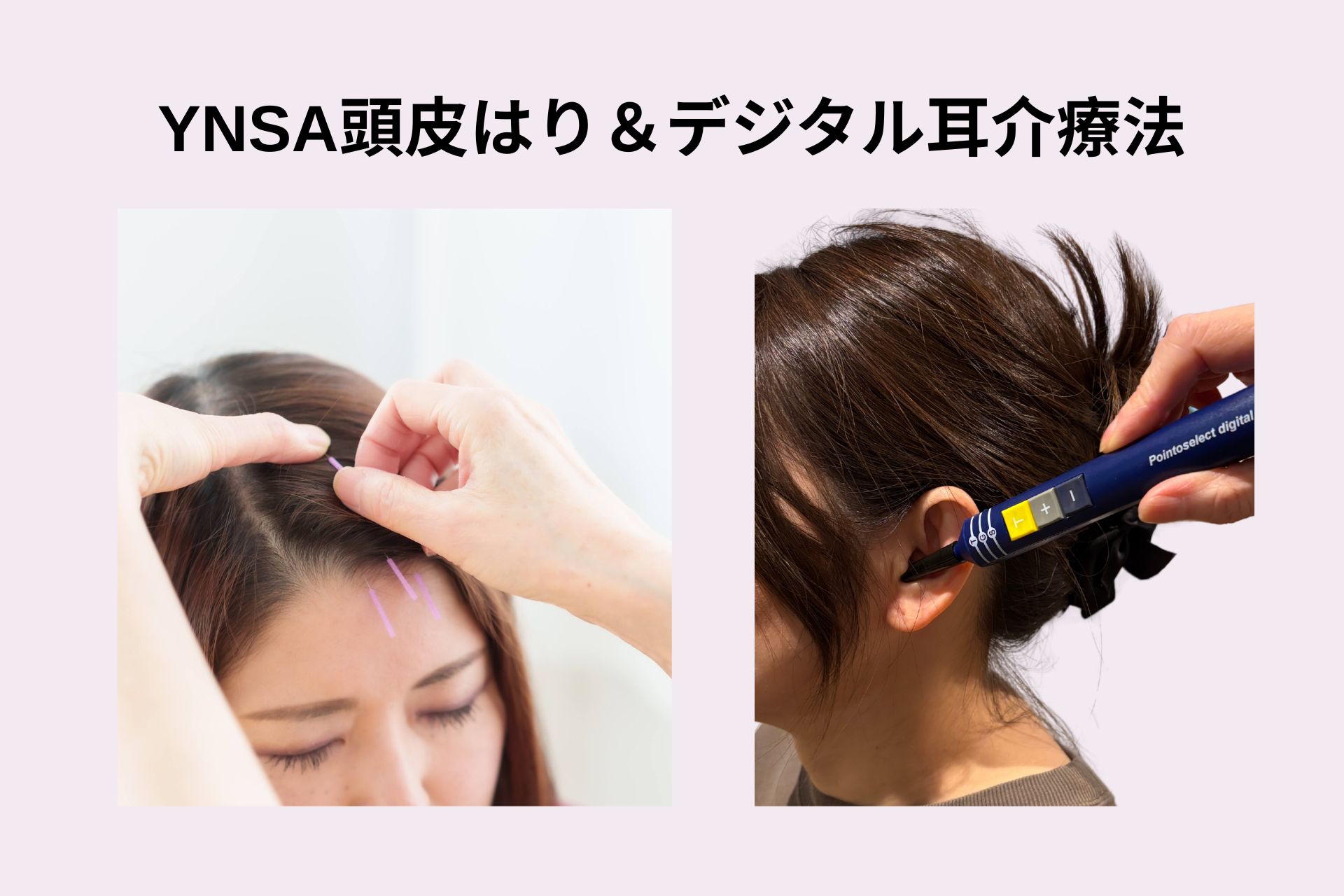 六本木鍼灸治療院フランシラ YNSA（頭皮はり）×　デジタル耳介療法（微弱電流）　　　のメニュー画像