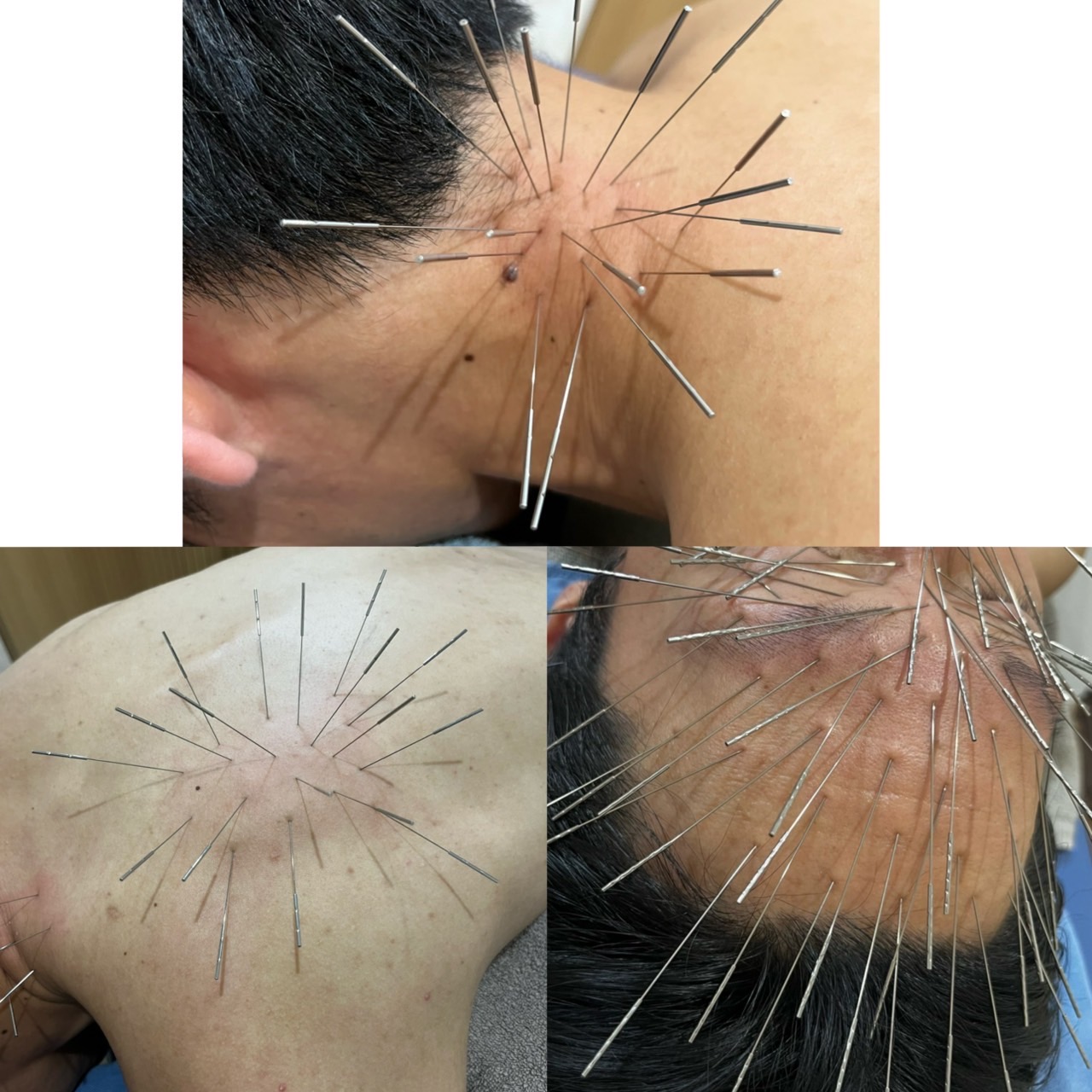 せせらぎ鍼灸院　ルート治療 ルート治療45分のメニュー画像