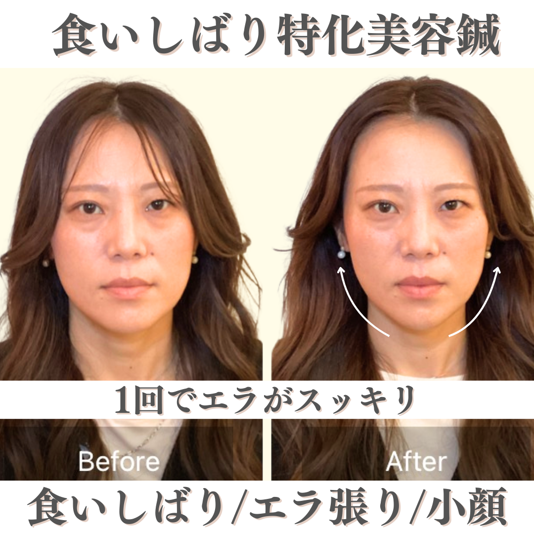 本町美容鍼灸サロンHARRIER −ハリアー− 【人気No.1エラ張りスッキリ◎】食いしばり特化美容鍼　通常14,300→5,500円のメニュー画像