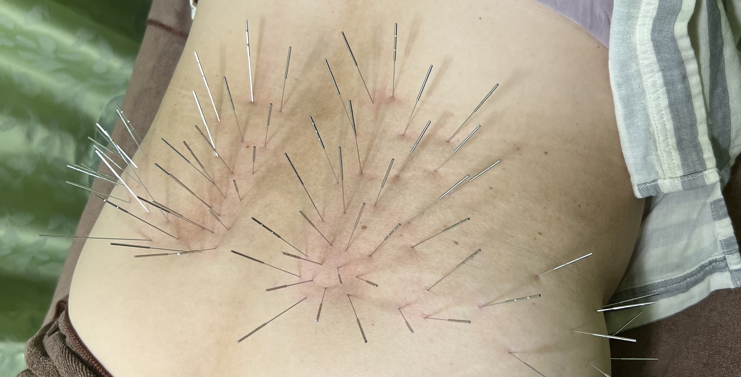 たいよう鍼灸整骨院conditioning labo 本格鍼灸ルート鍼(コリを徹底破壊💥)のメニュー画像
