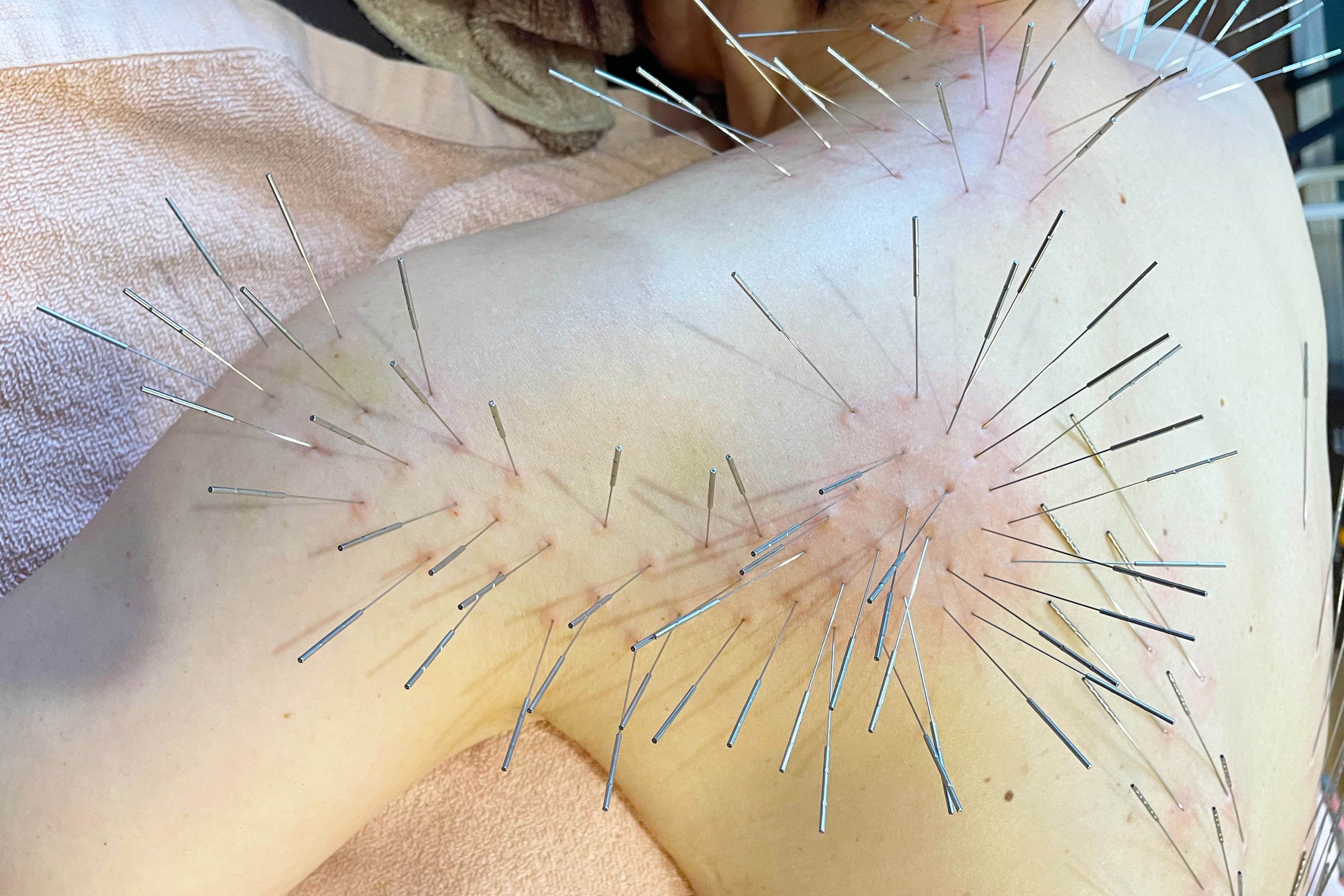ルート鍼灸治療院ほむら ルート鍼1枠のメニュー画像
