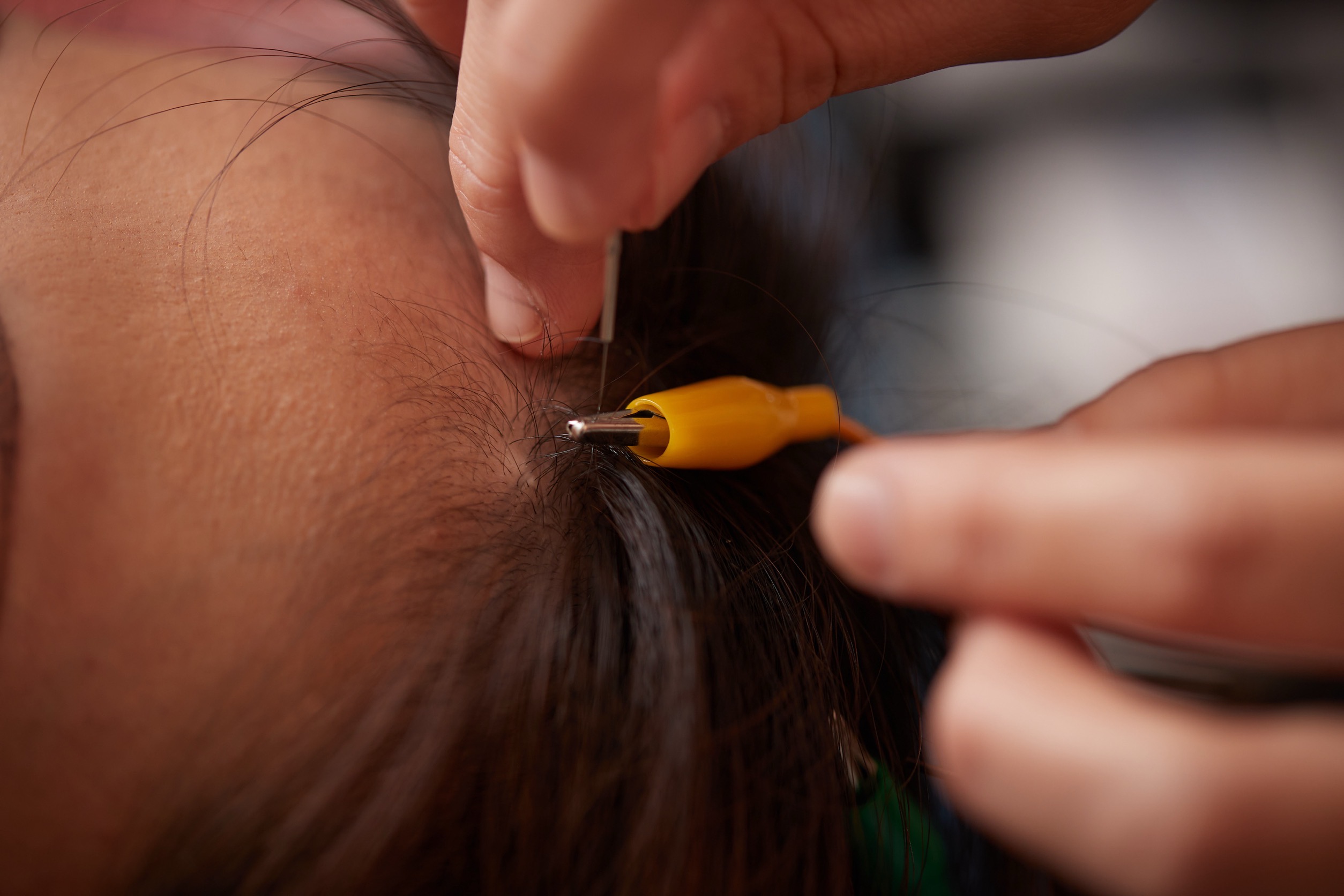 美楽鍼 リフトアップ美容鍼12のメニュー画像