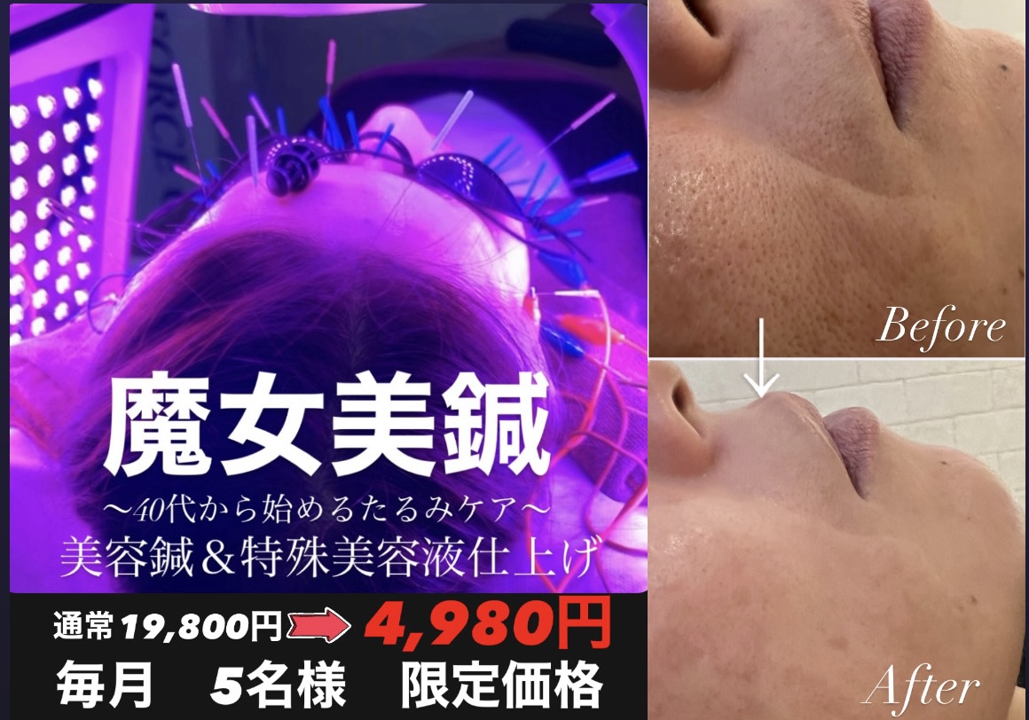 HaRick 美容鍼灸整体 \新規5名様限定!/ たるみを根本から改善✨ 【90日集中リフトアッププログラム】 初回体験 4,980円のメニュー画像