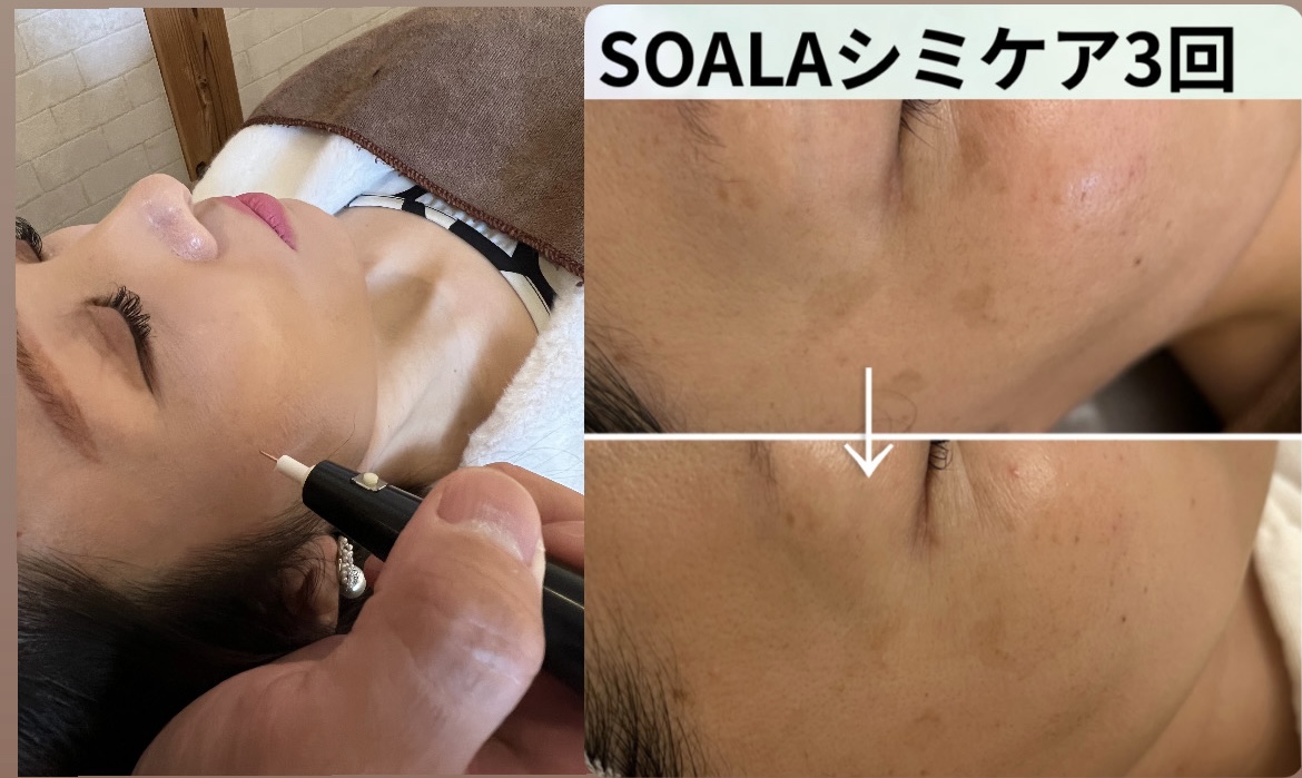HaRick 美容鍼灸整体 初回限定✨ 透明感アップ シミケア オプションのメニュー画像