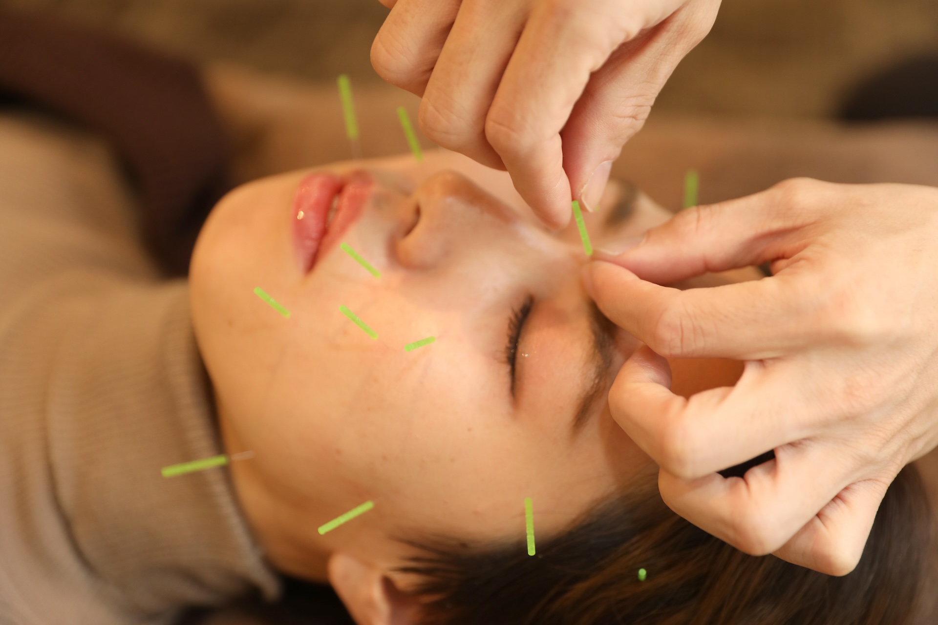 イーエックス鍼灸院 【たるみ改善特化コース】肌内面から若々しい印象へ♪ 60分￥9,900→￥3,980のメニュー画像