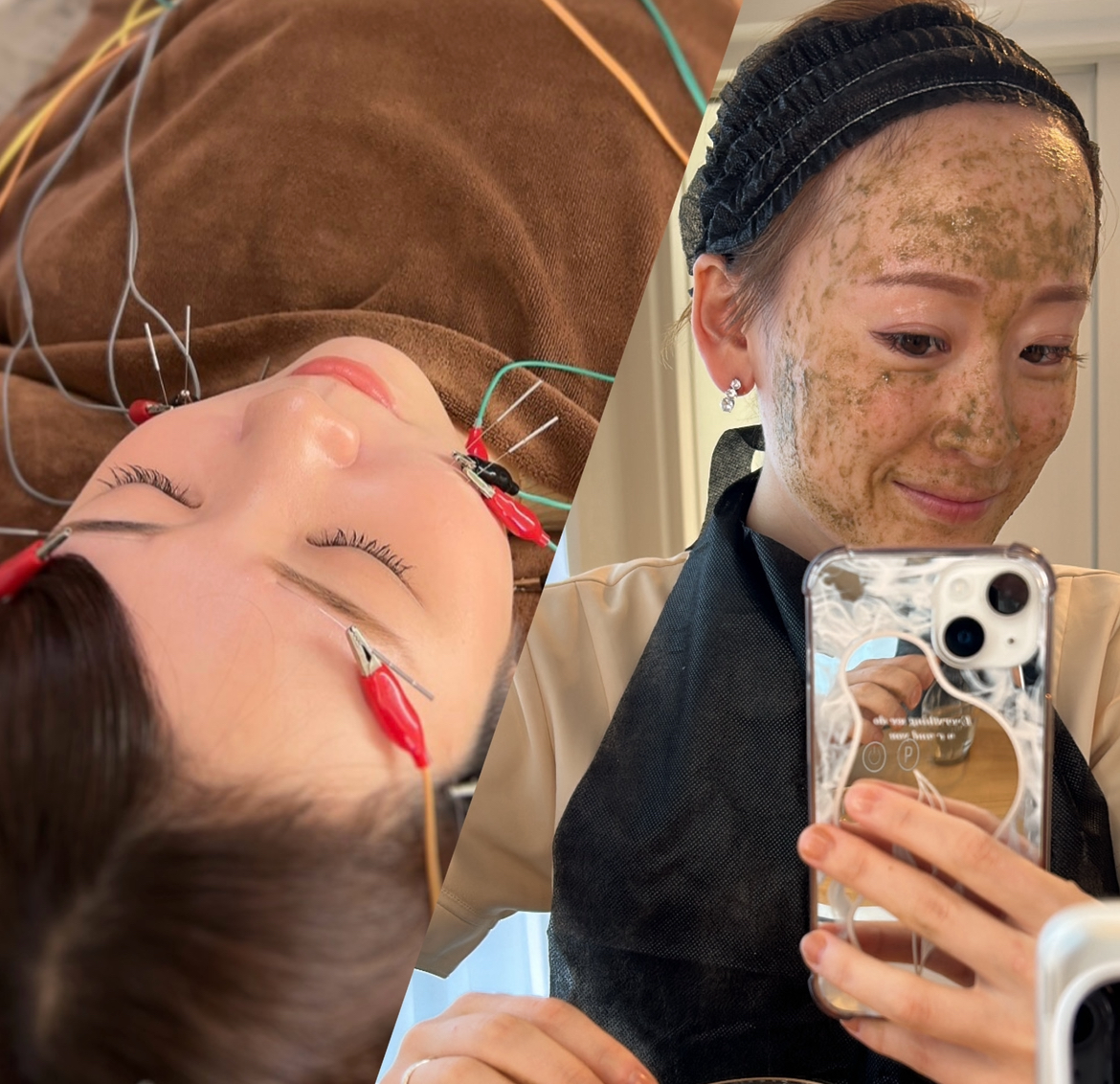 コトハリ 《初回✨美肌セット》電気を流す美容鍼×ハーブピーリングのメニュー画像