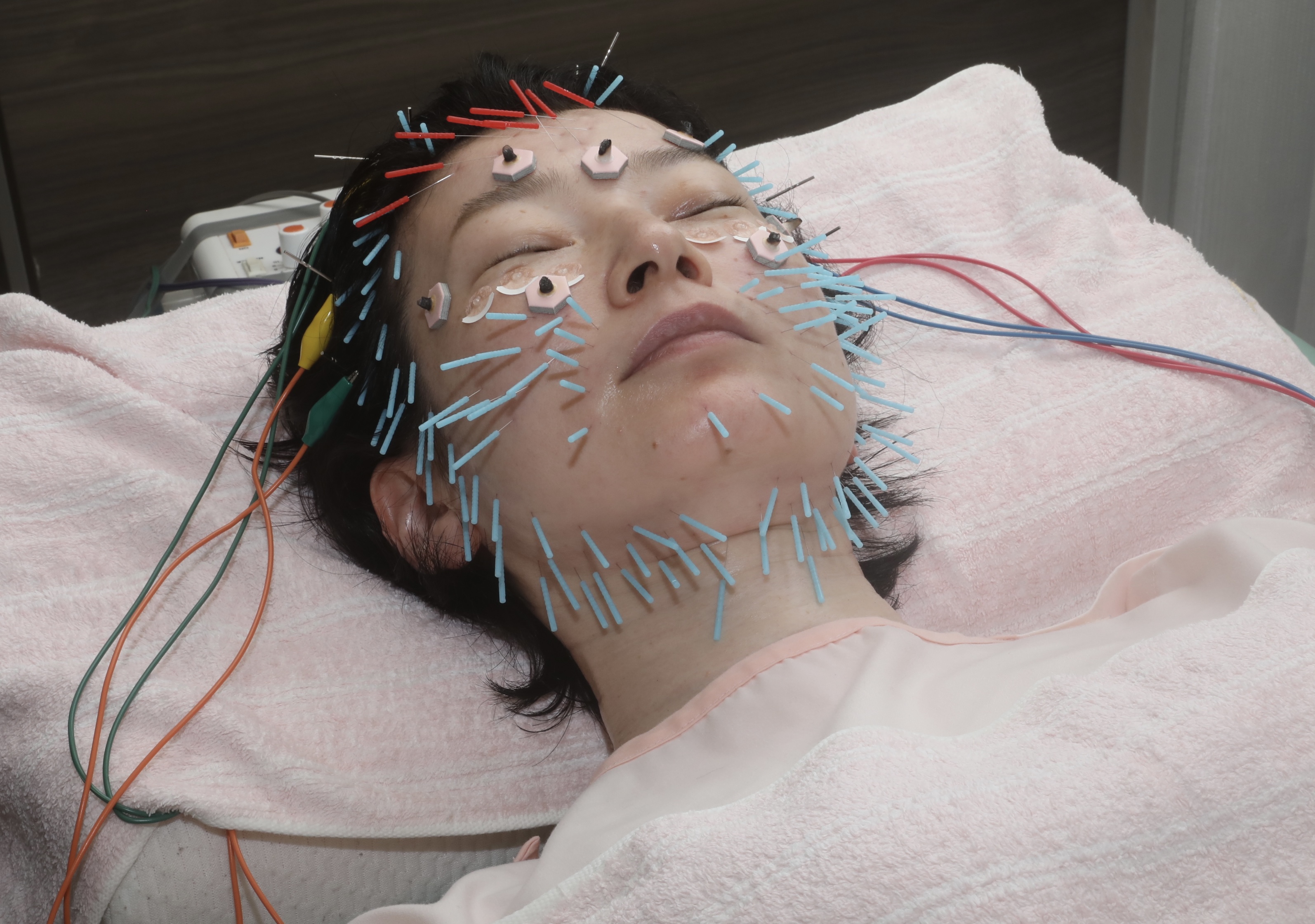おべ鍼灸院 オーダーメイド　美容鍼のメニュー画像