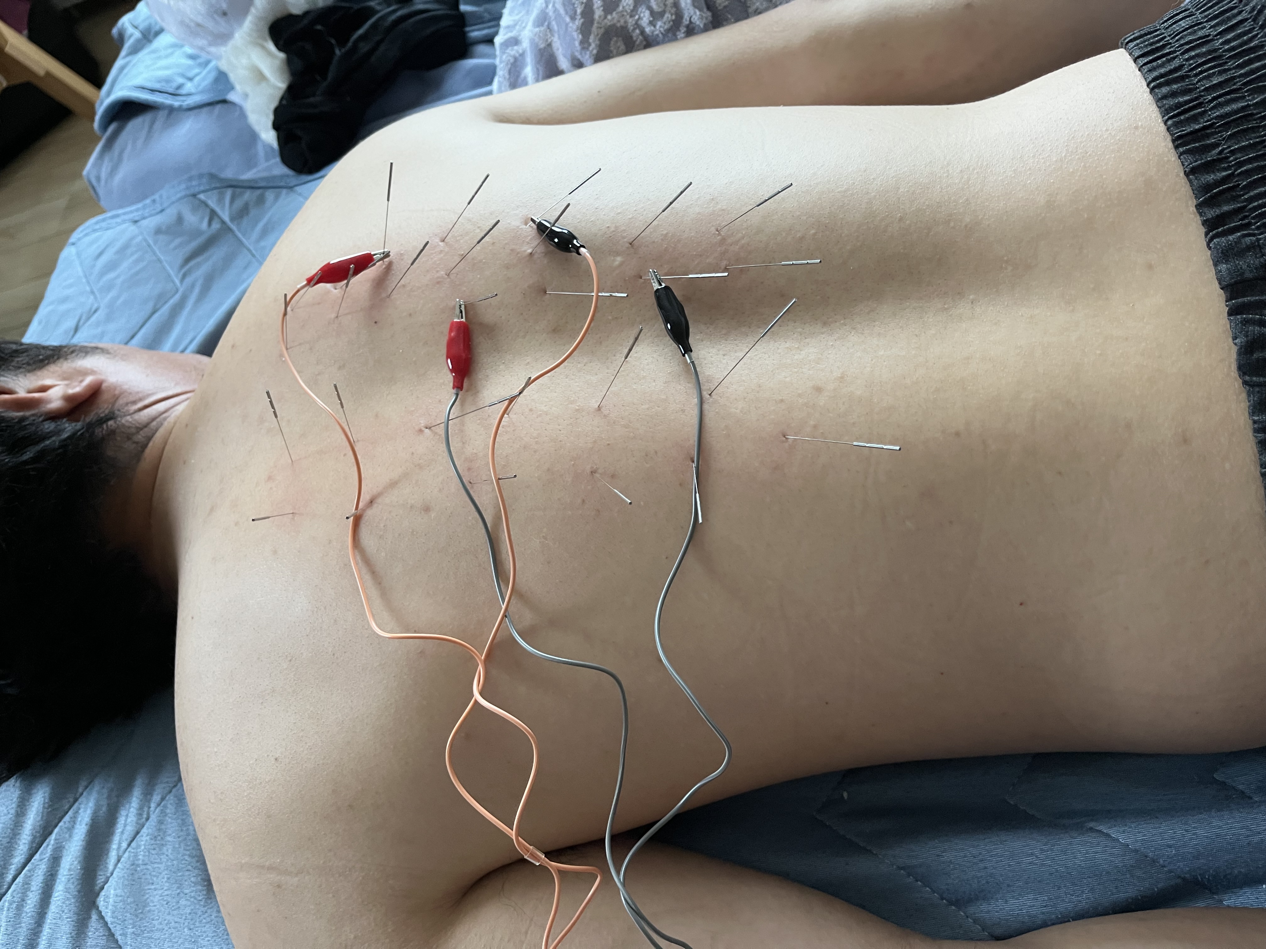 【出張鍼灸】ルート鍼専門　志 電気鍼治療のメニュー画像