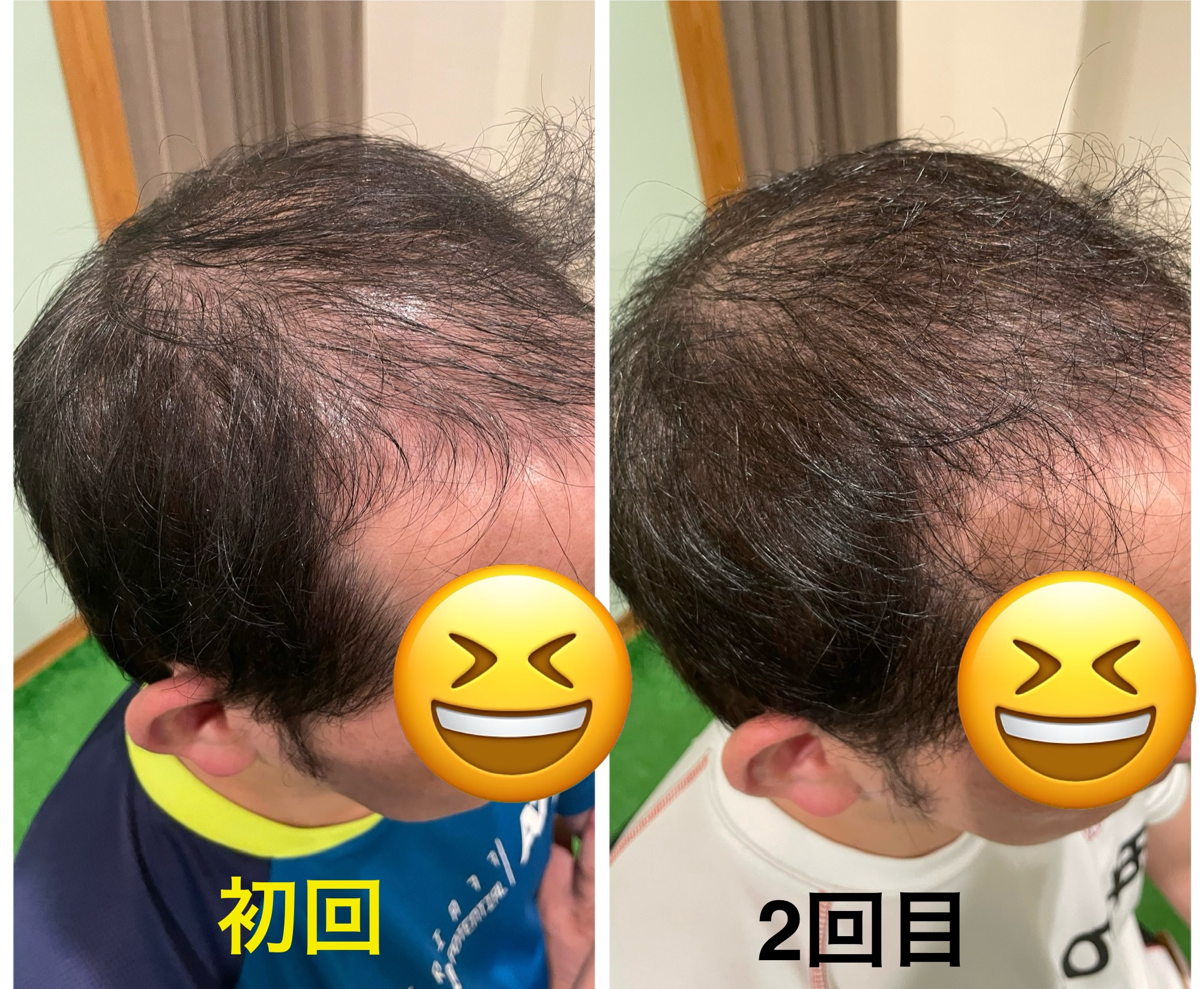 Akira鍼灸Conditioning Lab 薄毛鍼灸ファーストクラス 5回コースのメニュー画像