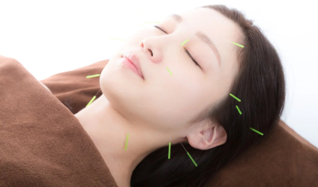 鍼灸院lokahi 【初回】美容鍼灸（お顔のトレーニング指導込み11,000円）/2回目以降　8,800円のメニュー画像