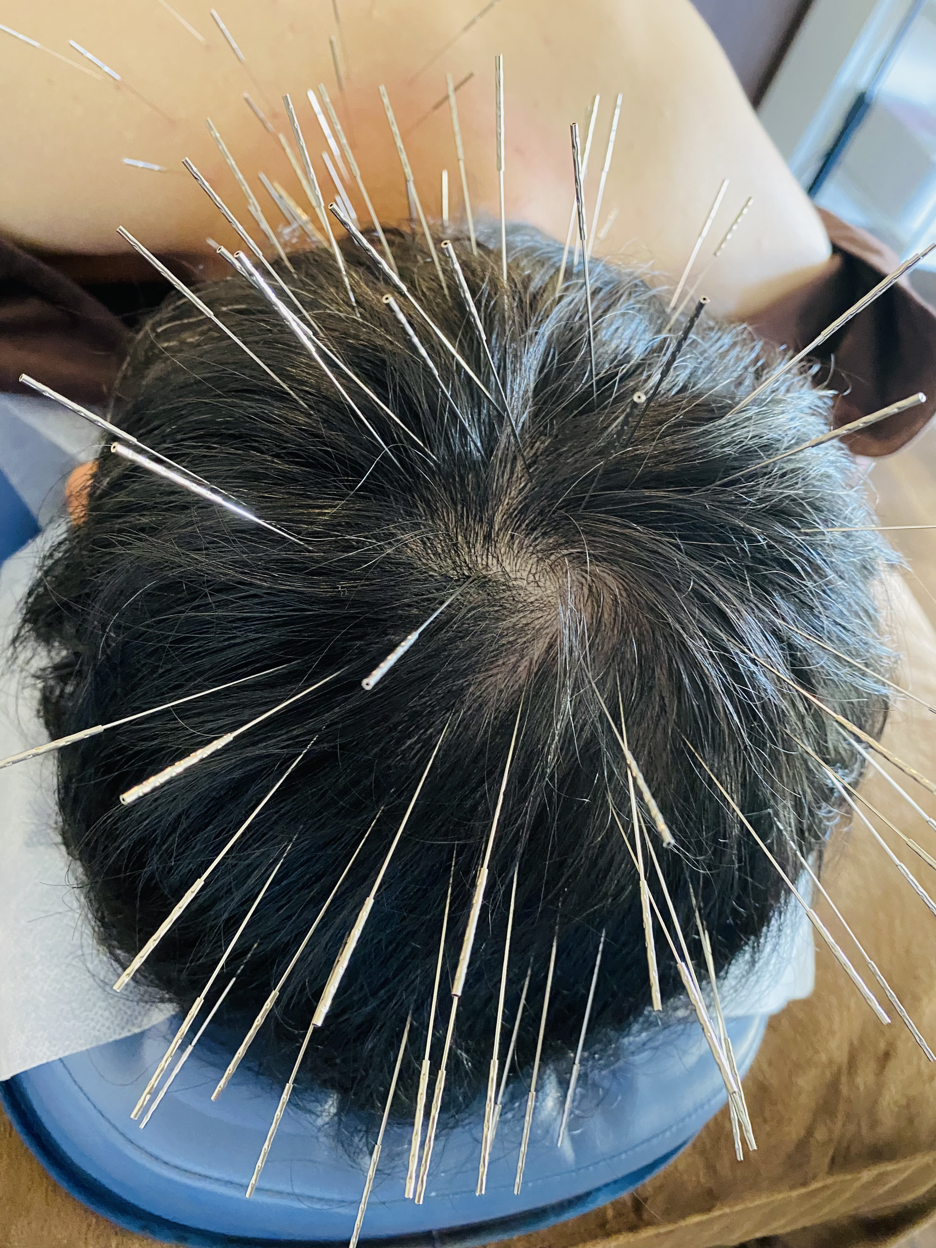 長﨑鍼療院【ルート治療認定院】 ルート治療(ショート)のメニュー画像