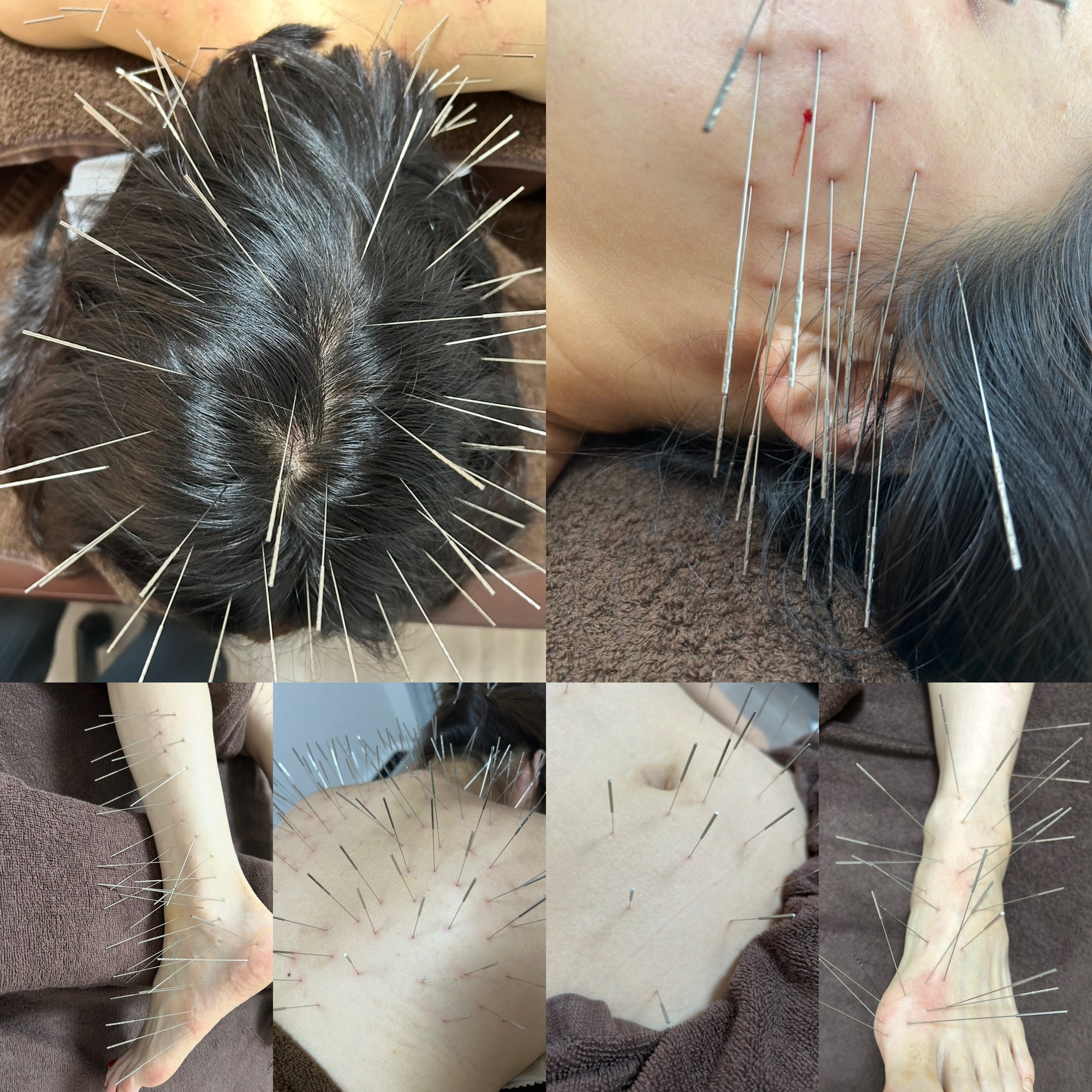 Iris鍼灸マッサージ上野院【ルート治療専門】 ルート治療　90分のメニュー画像