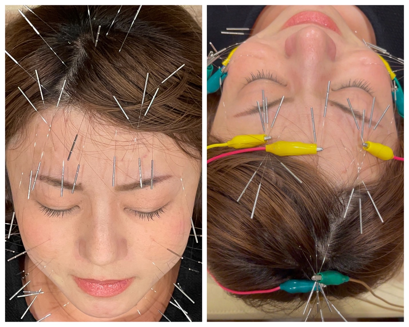 からほり　野の花堂 アンチエイジング美容鍼のメニュー画像