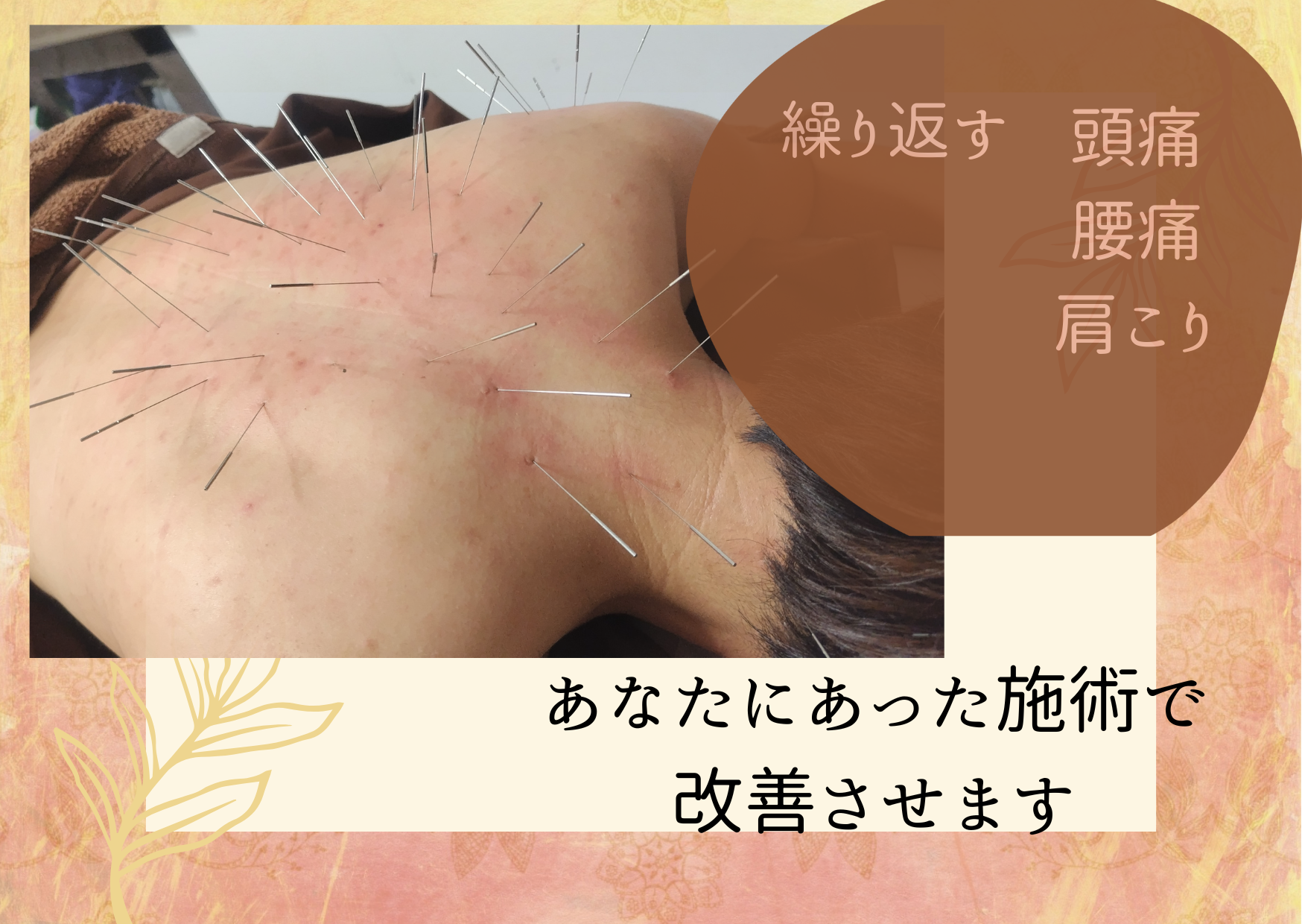 ポイントはり・きゅう治療院 ルート治療40分（1-3部位）のメニュー画像