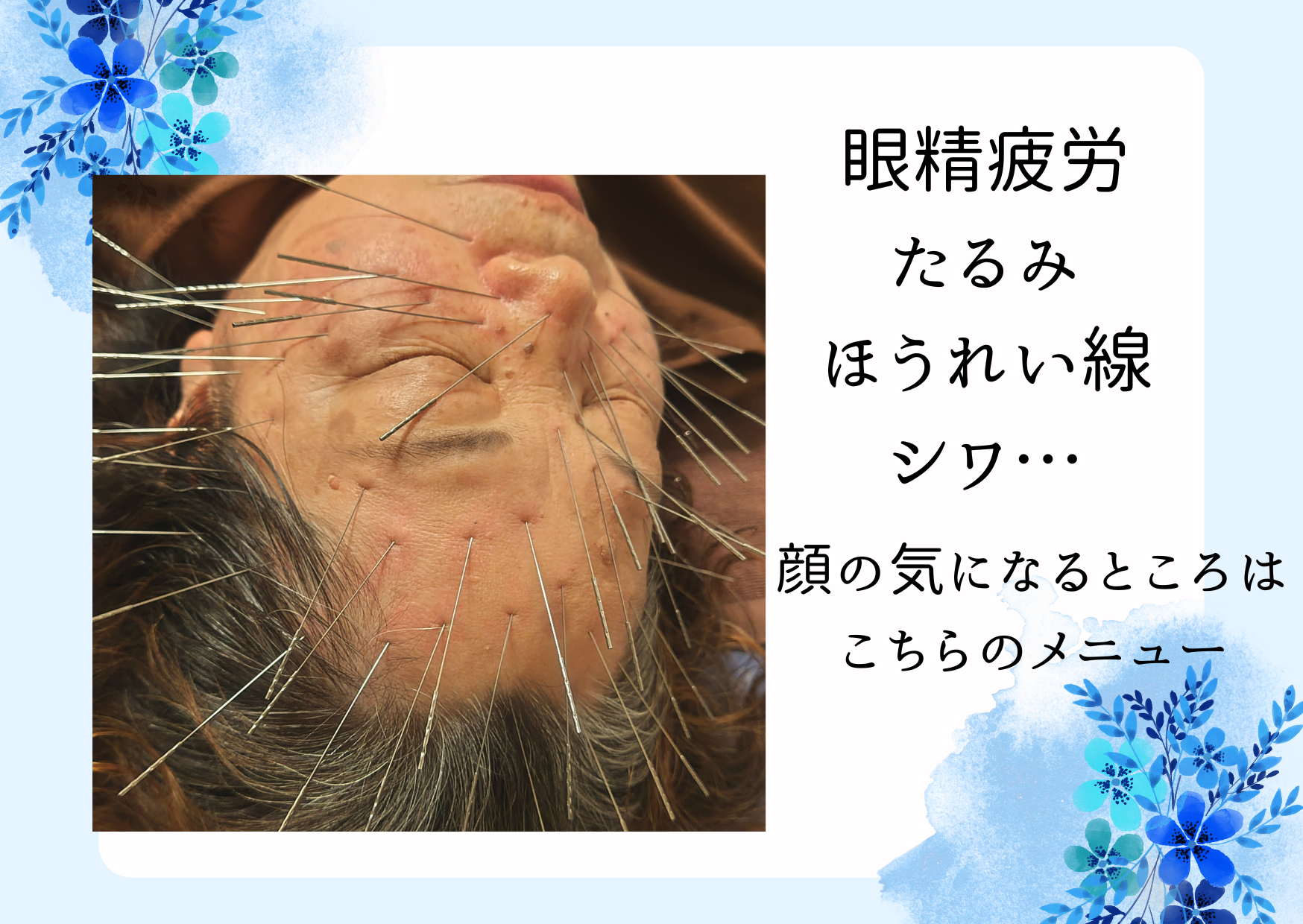 ポイントはり・きゅう治療院 鬼美容鍼40分（顔・頭）のメニュー画像