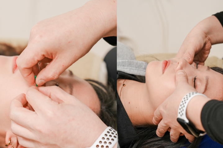 美容温熱整体鍼Miolus/もりいち鍼灸 小顔矯正＆美容鍼のメニュー画像