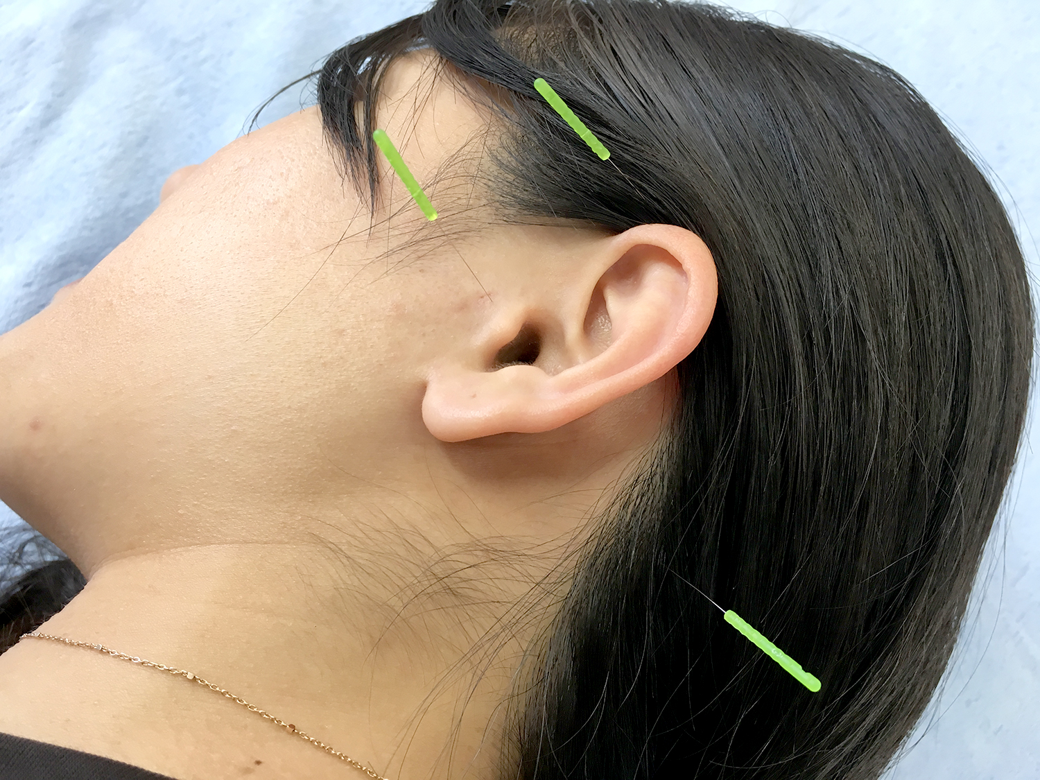難聴、めまい・起立性調節障害・腰痛・肩の痛み・薄毛なら当院にお任せください！ともろ鍼灸院（剛鍼灸院グループ） めまい・メニエール病のメニュー画像