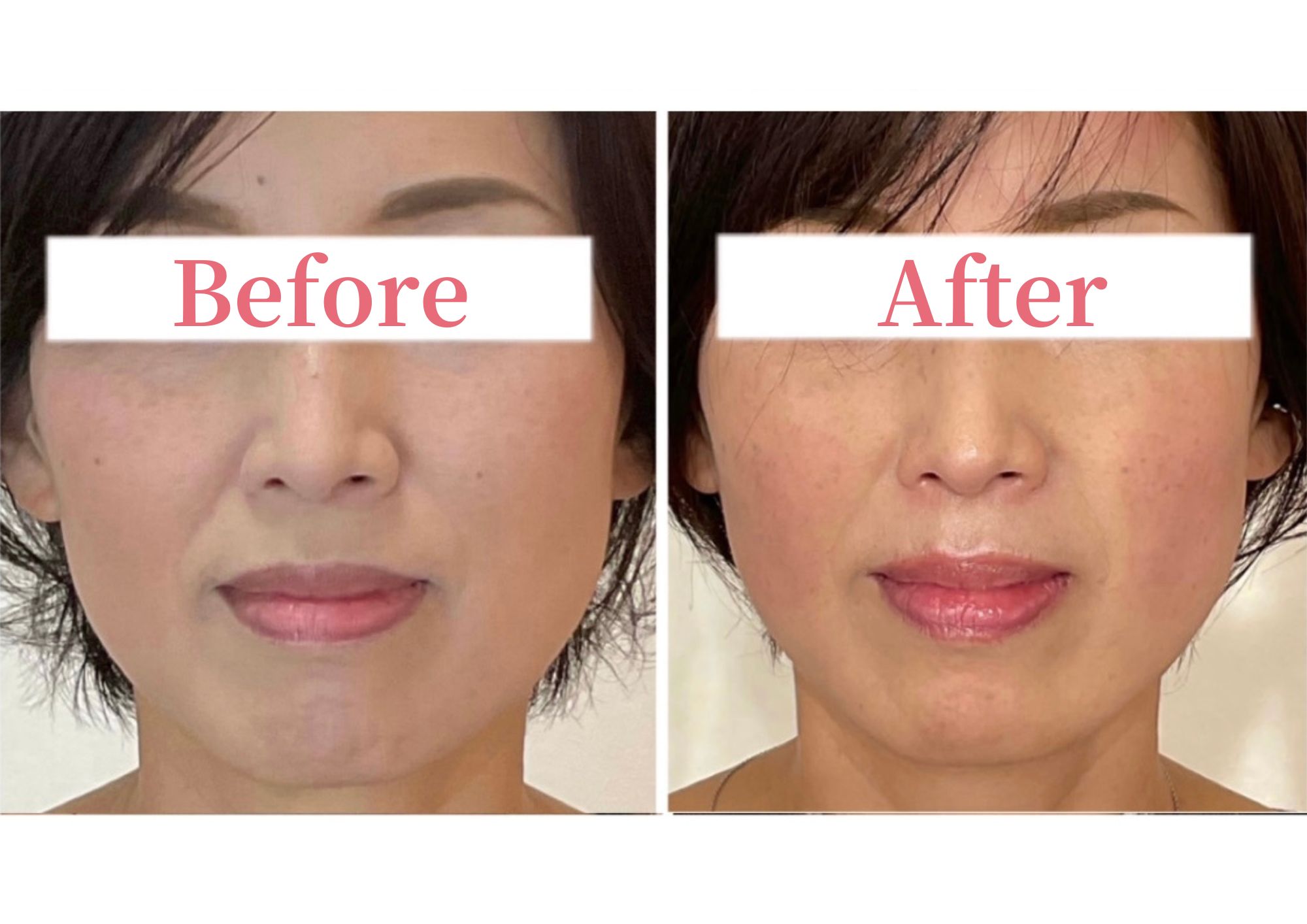 −美容鍼・小顔専門−鍼灸CiruelaValle 【咬筋の暴走】『エラ張り撃退美容鍼』通常15000円→初回2000円のメニュー画像