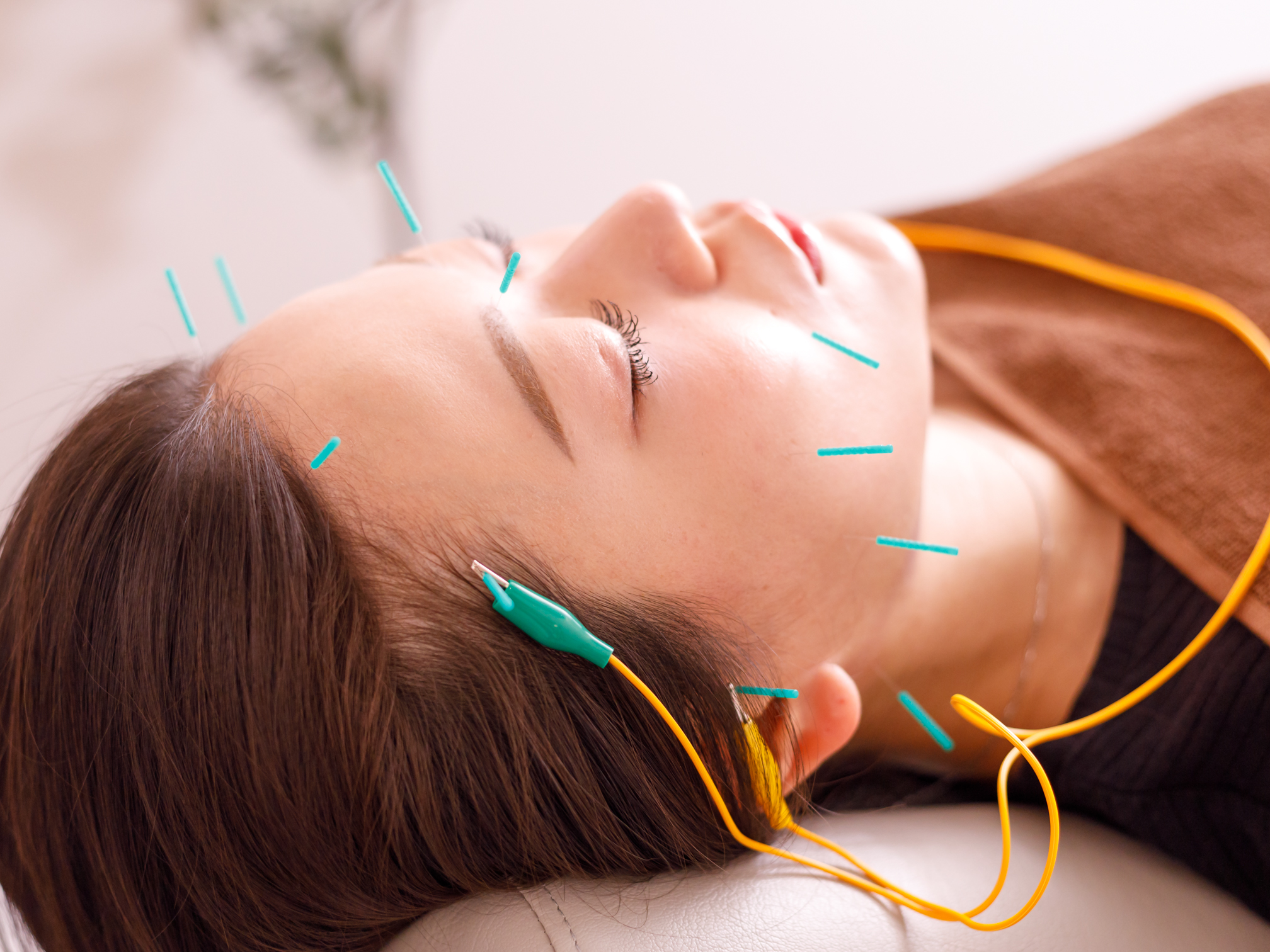 整体と美容鍼　無名 人気No.1【リフトアップ特化美容鍼】フェイスライン/ほうれい線/食いしばり解消のメニュー画像