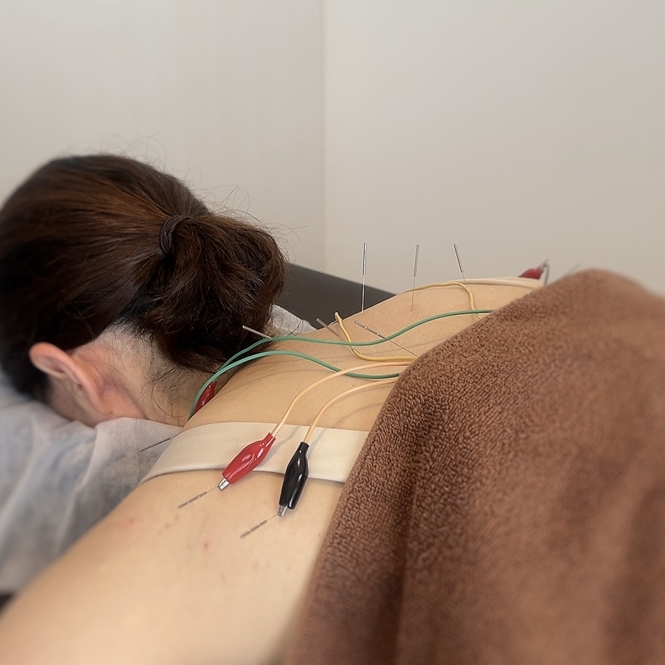 コトハリ 【人気No.1】ご新規様 →電気を流す美容鍼+からだの鍼のメニュー画像