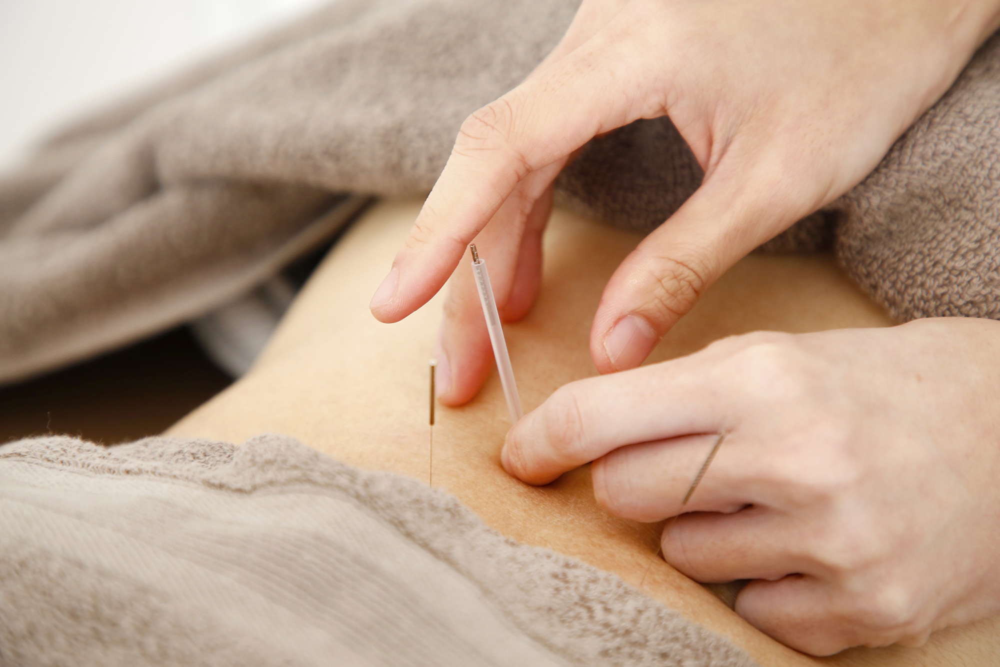 あかつき鍼灸接骨院　上福岡院 鍼灸治療（２部位）のメニュー画像