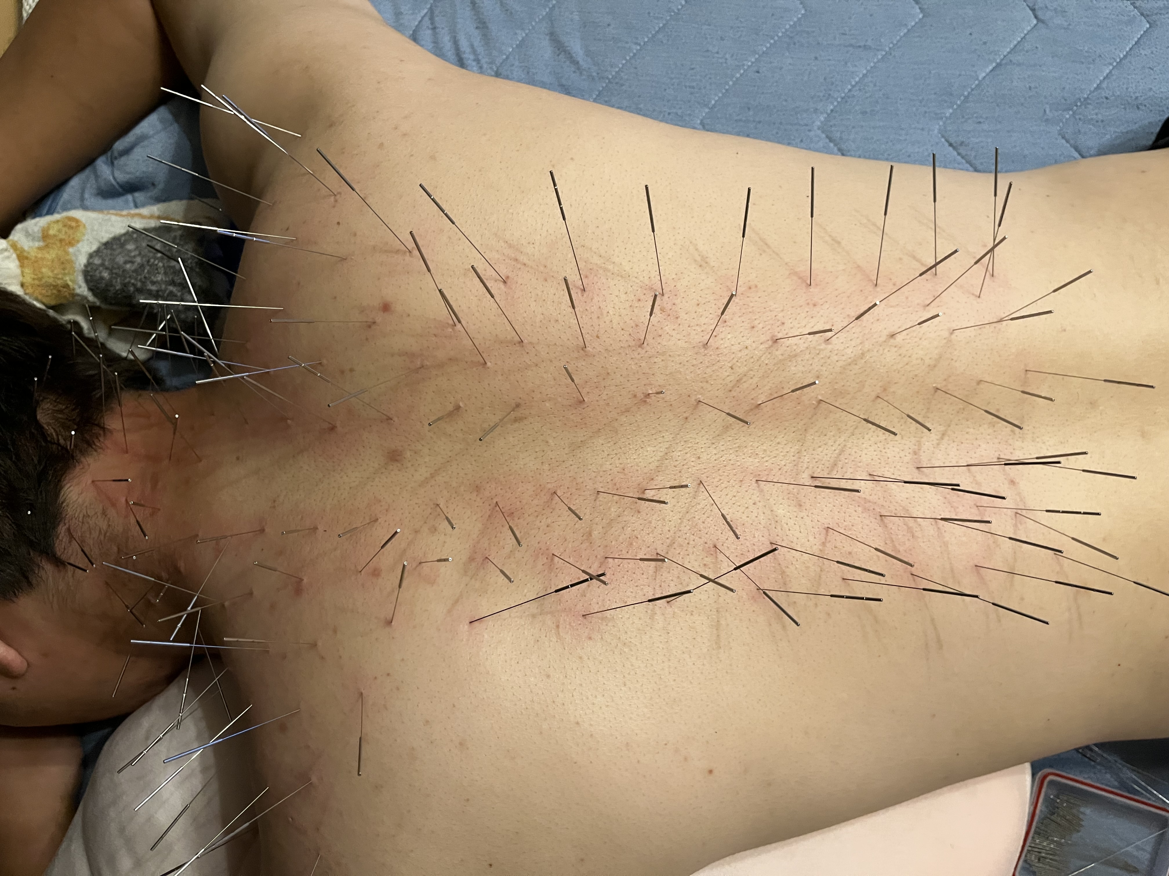 【出張鍼灸】ルート鍼専門　志 ルート鍼または整体のメニュー画像