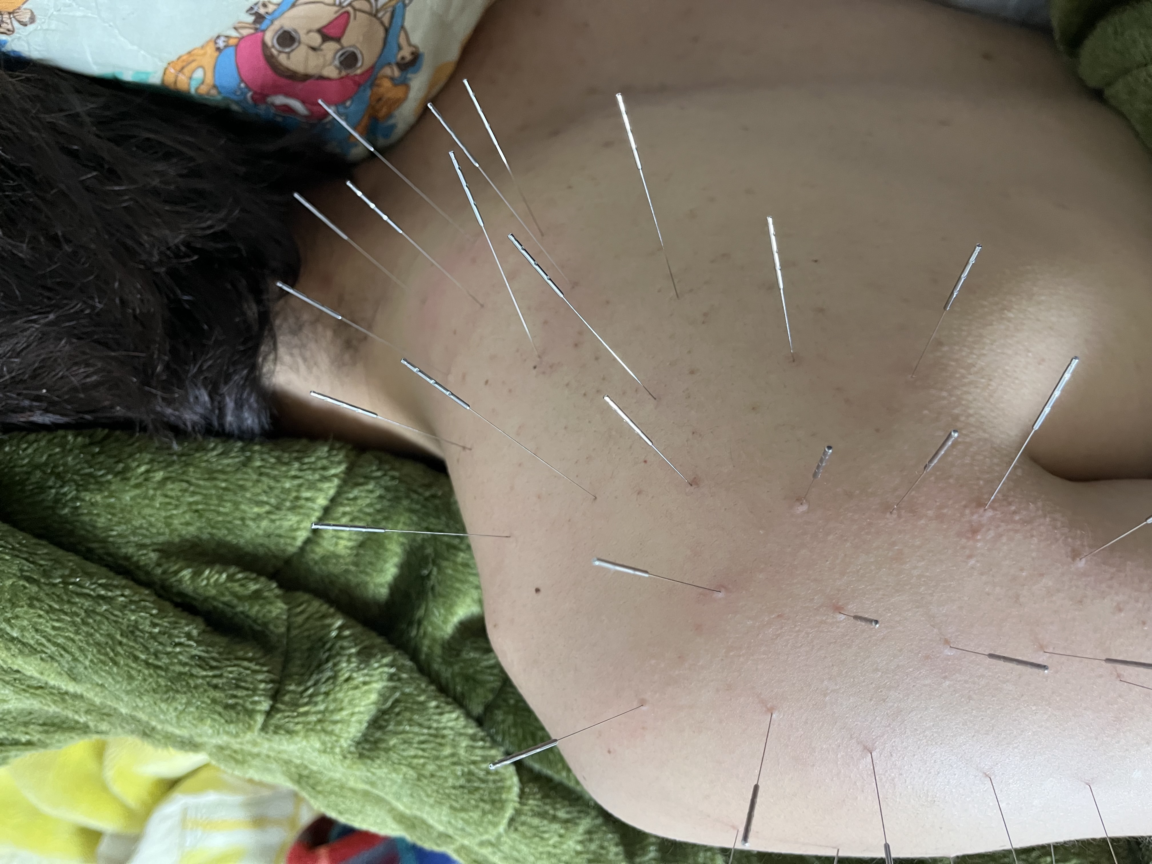 【出張鍼灸】ルート鍼専門　志 ルート鍼または整体のメニュー画像