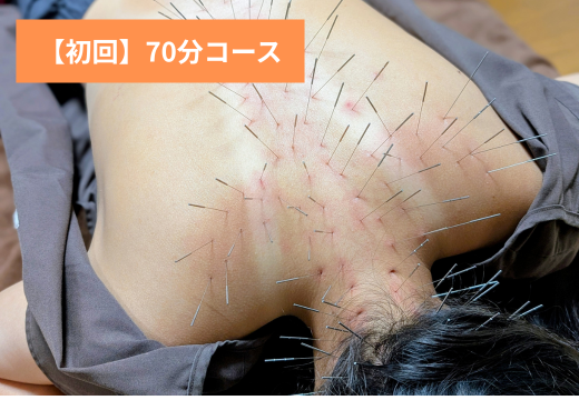 はり灸マッサージSOLE LUNA 【はじめての方】ルート鍼（多鍼）治療70分　改善効果：GOODのメニュー画像
