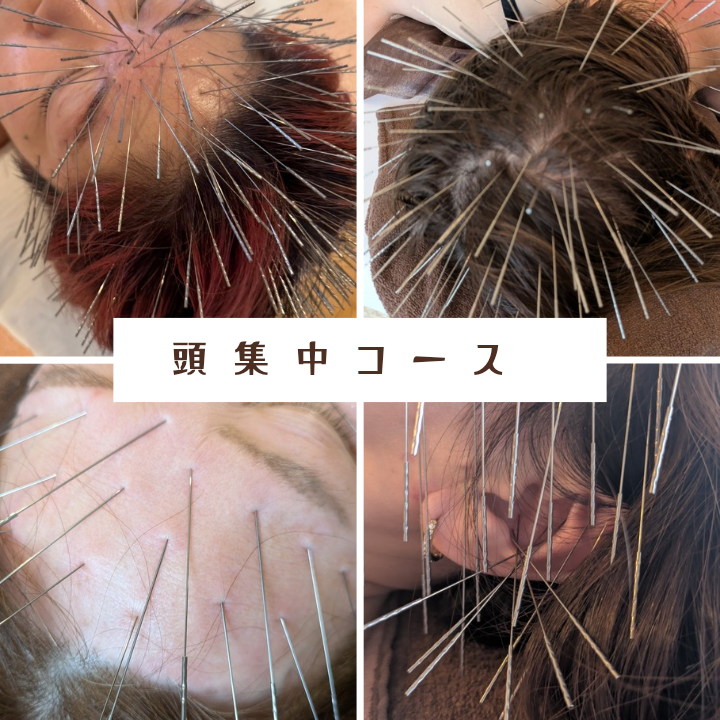 ルート鍼灸治療院ほむら 頭集中コースのメニュー画像