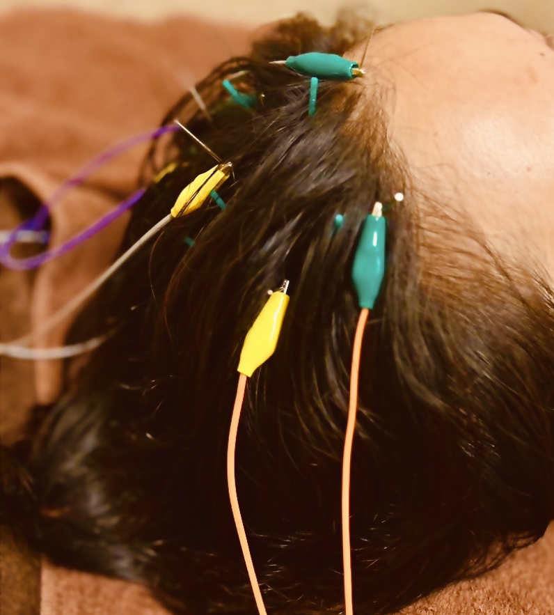 Asi鍼灸院 【睡眠改善30分】のメニュー画像