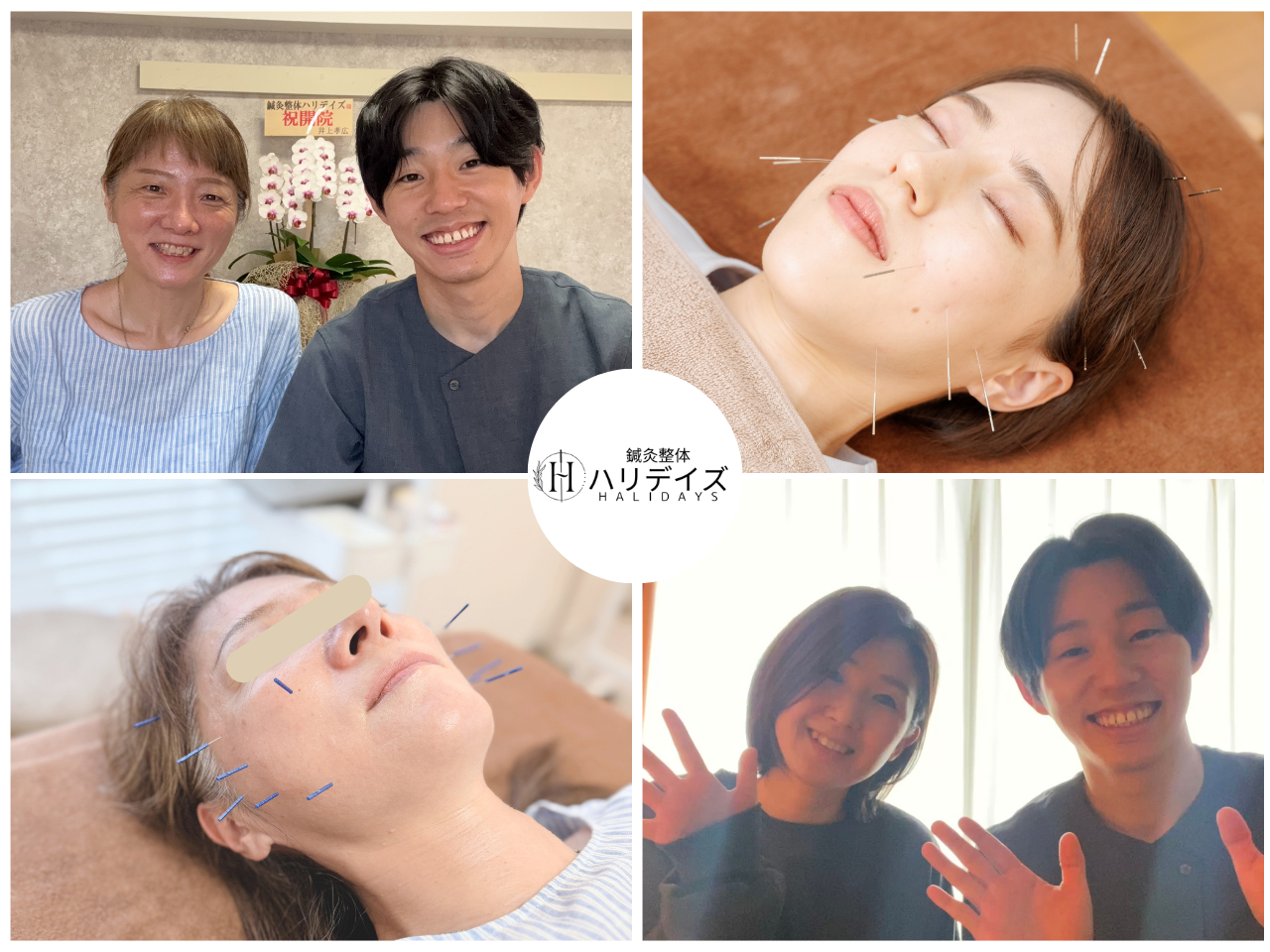 【八王子の肩こり/腰痛/ひざ痛】鍼灸整体ハリデイズ 【初回限定】【たるみ＆表情疲れが気になる】瞬間リフトアップ★美容鍼＋首肩ケア25分のメニュー画像