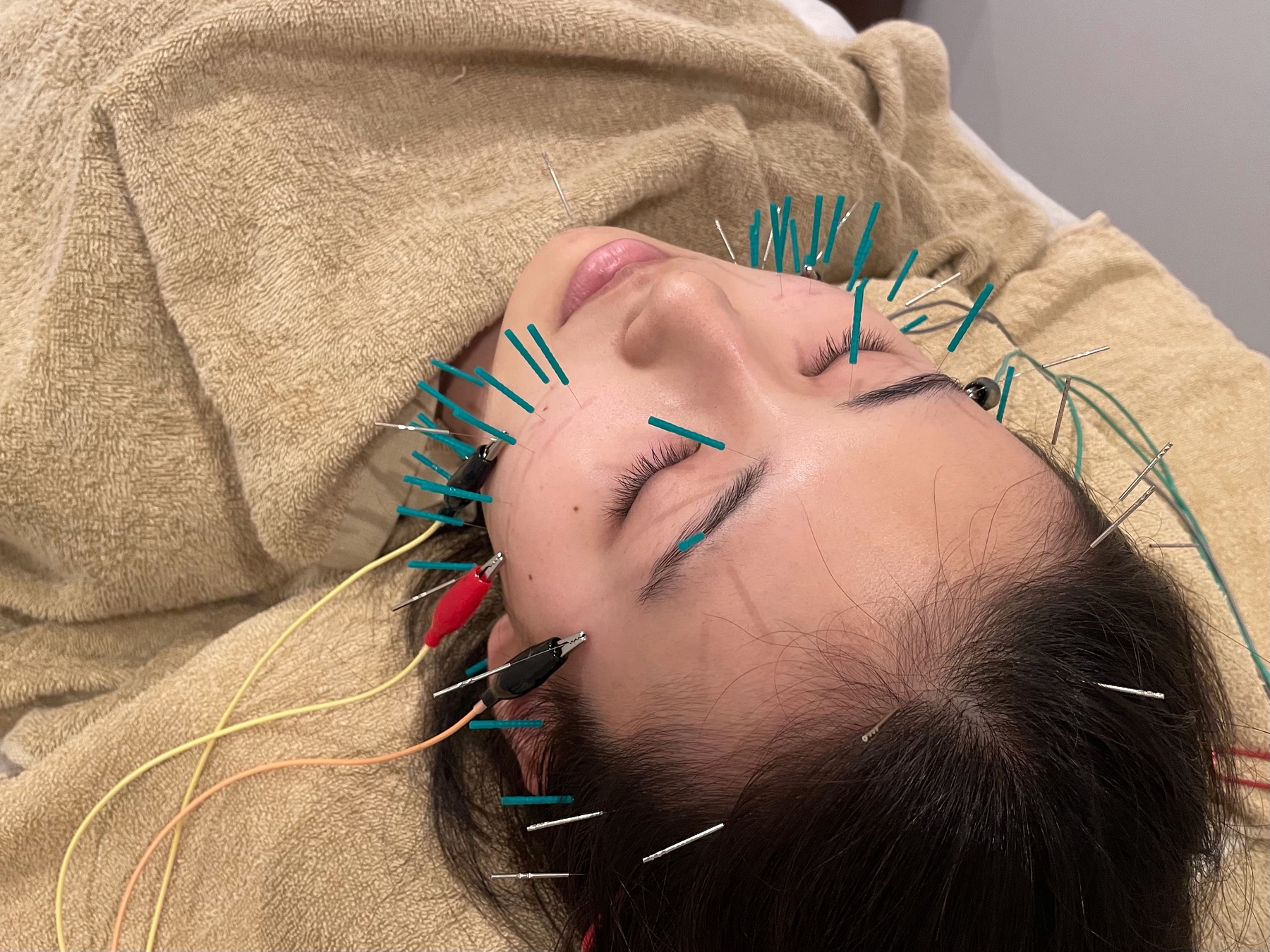 美容鍼灸サロンYURARA 【ご新規様】美容鍼×耳つぼトライアル≪美容鍼×耳つぼ×ヘッドスパ≫のメニュー画像