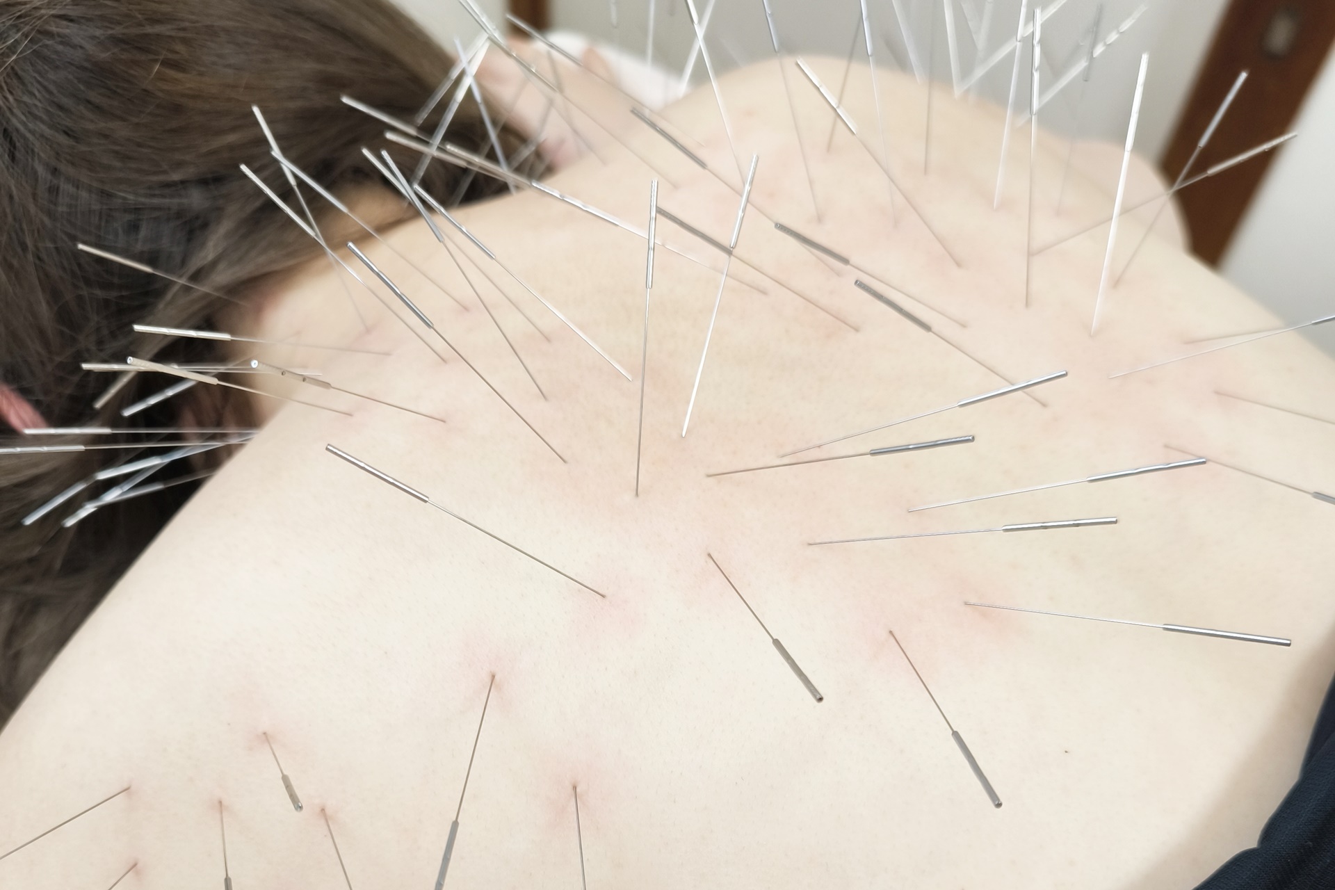 きやま鍼灸治療院  【ルート治療専門院】 ルート治療（ショート）のメニュー画像