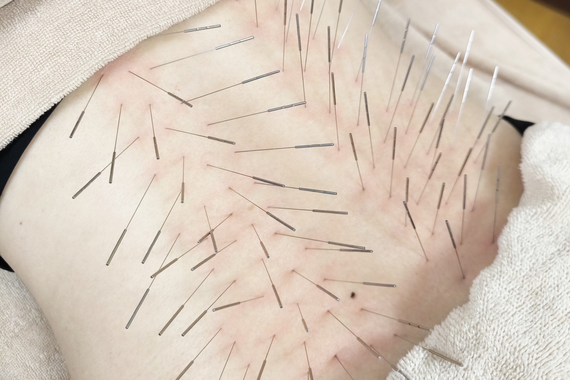 きやま鍼灸治療院  【ルート治療専門院】 ルート治療　（スタンダード）のメニュー画像